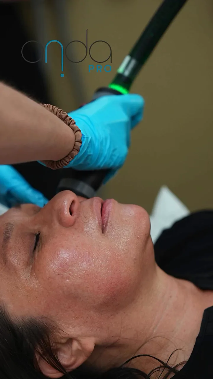 The small Coolwaves® handpiece moving across the cheek and lower face during an ONDA Pro facial session at Reviv Med Spa, Millbrae — a frame from the practice’s own reel.