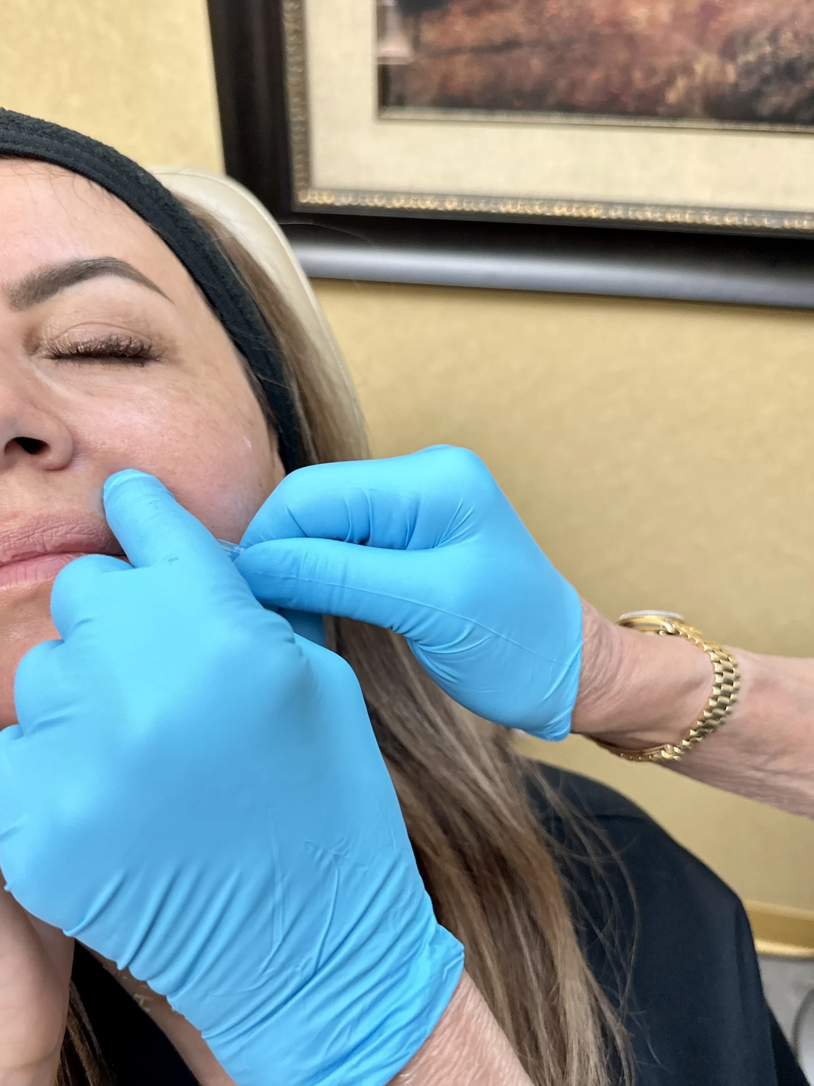 A facial injectable being placed at the cheek during a treatment at Reviv Med Spa, Millbrae, California