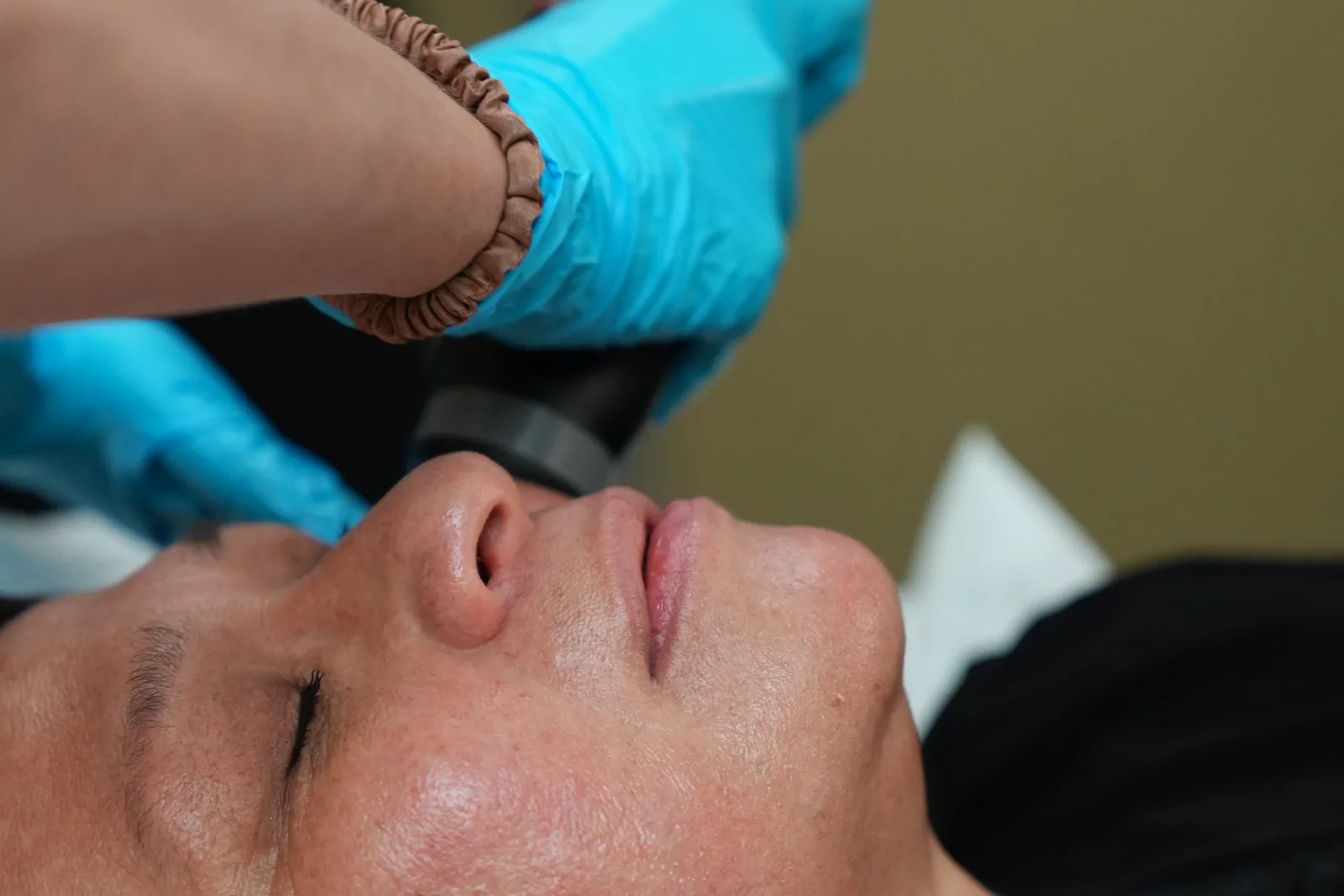 A no-downtime ONDA Pro facial contouring session at Reviv Med Spa, Millbrae.
