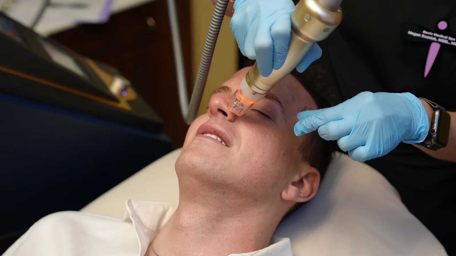 Sylfirm X RF microneedling for a male patient at Reviv Med Spa, Millbrae