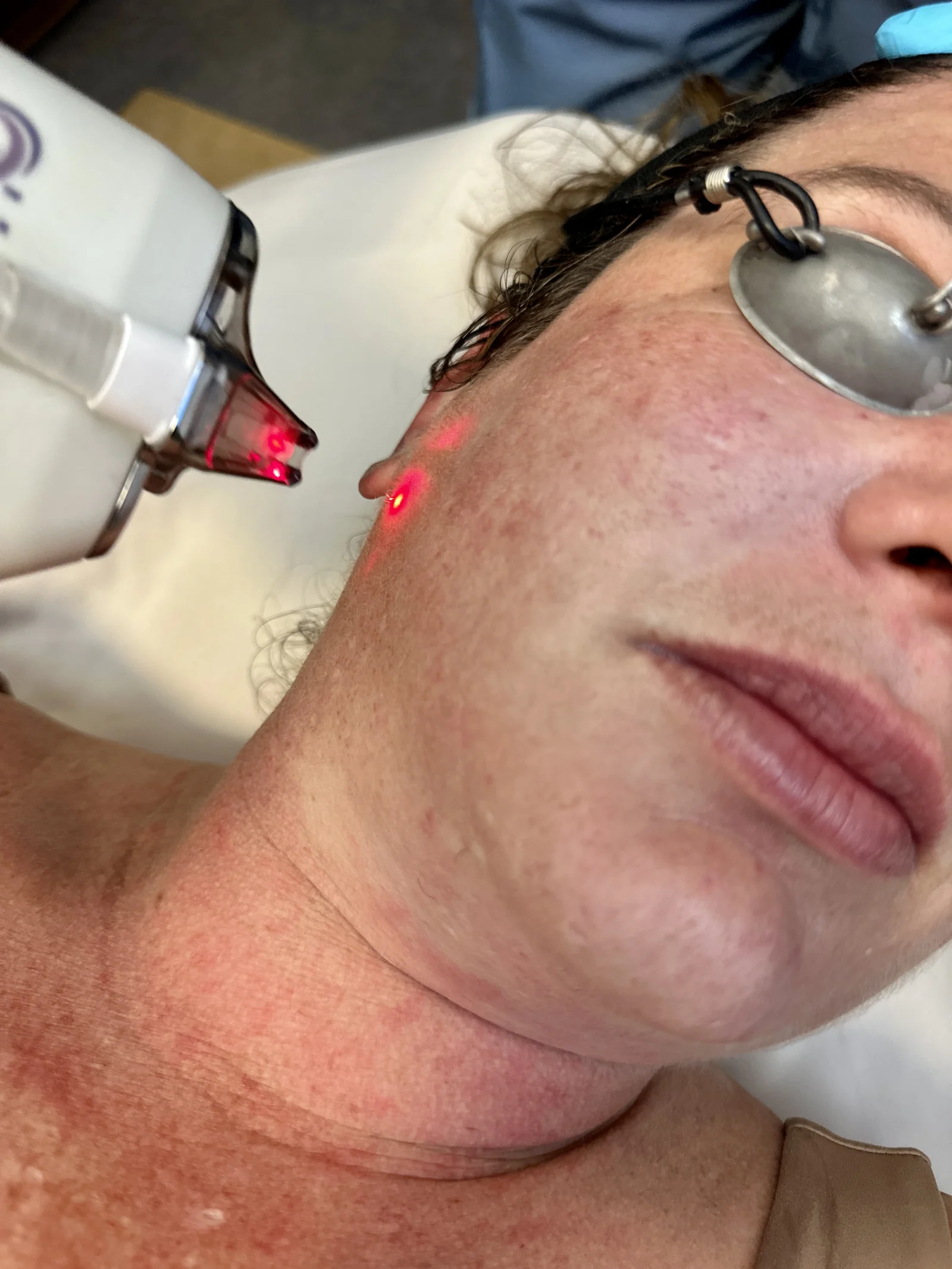 BBL Hero photofacial in progress with safety eyewear