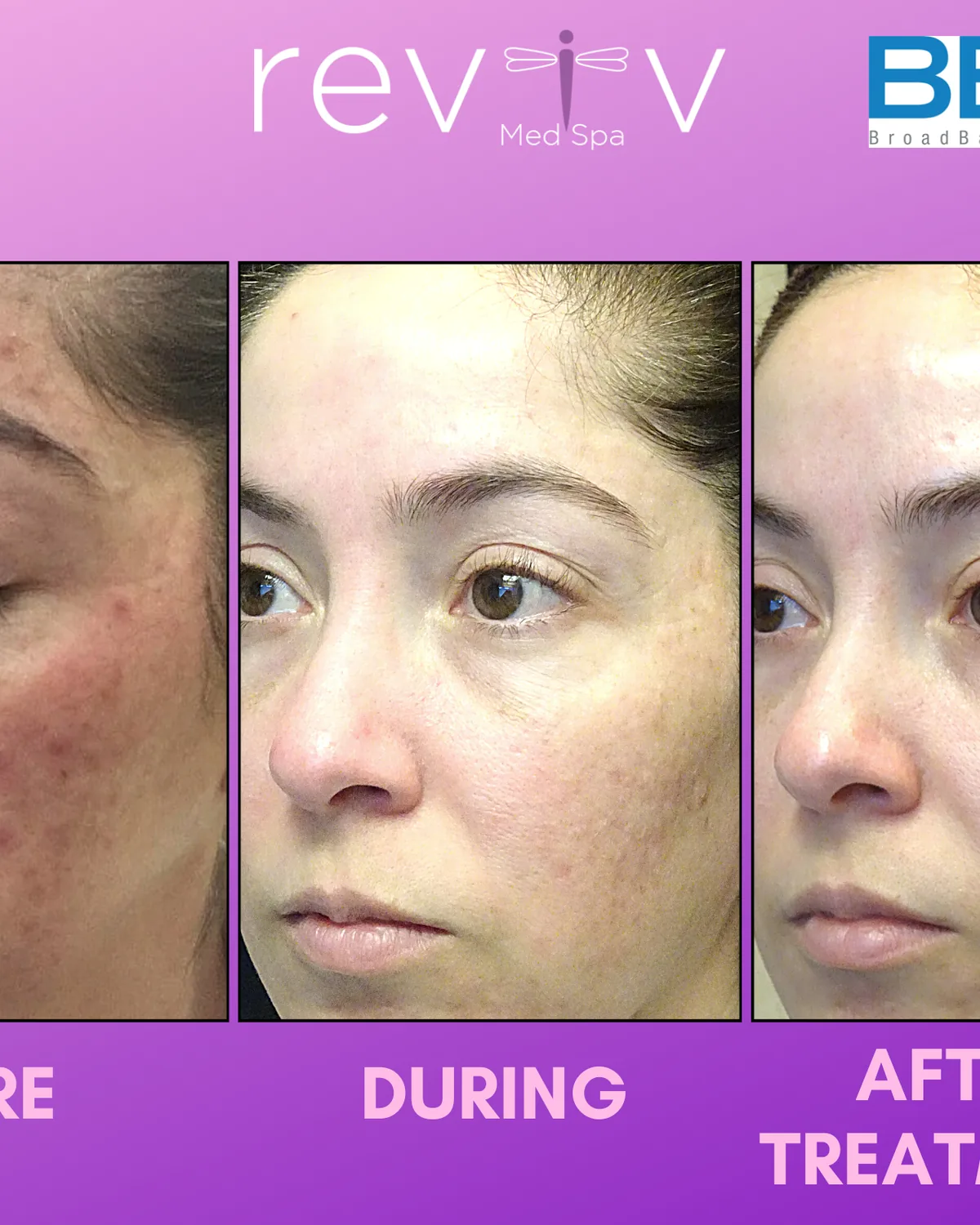 BBL Hero Photofacial