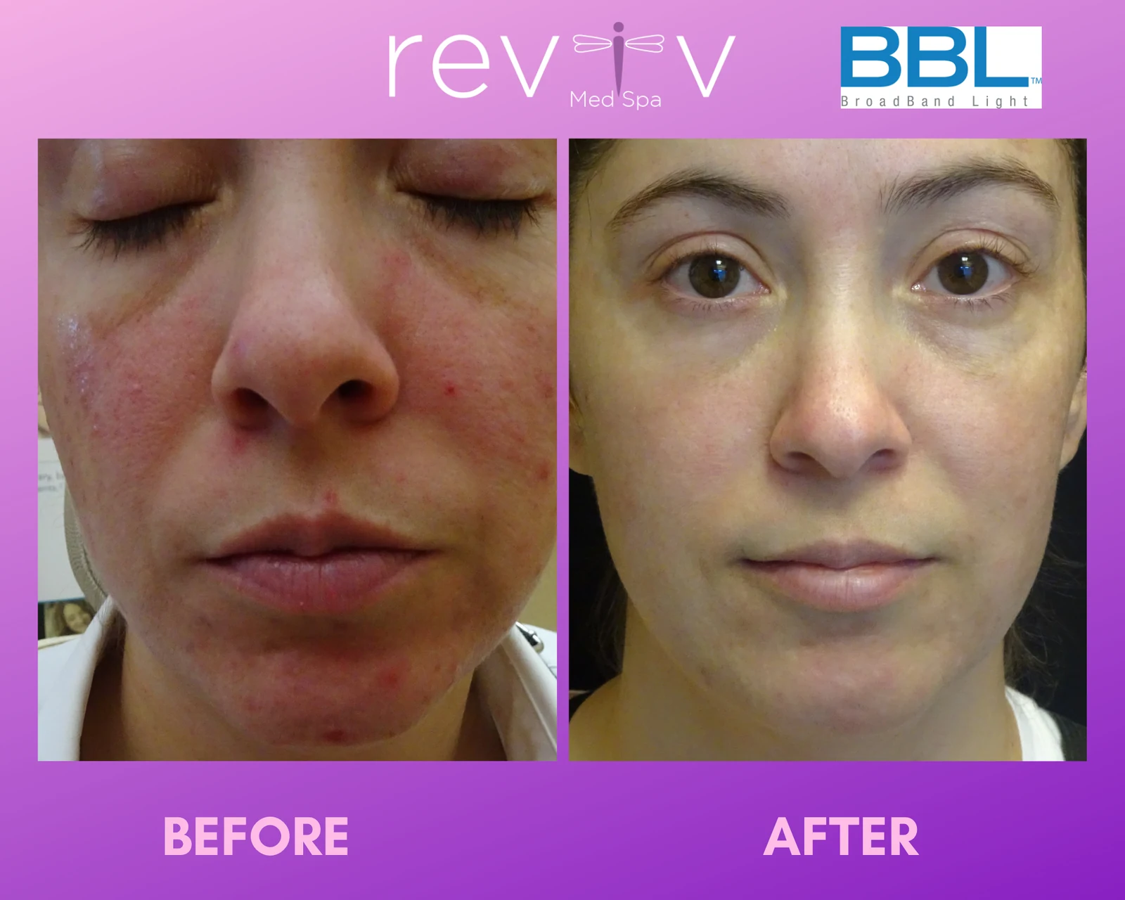 BBL Hero photofacial before and after — facial redness cleared