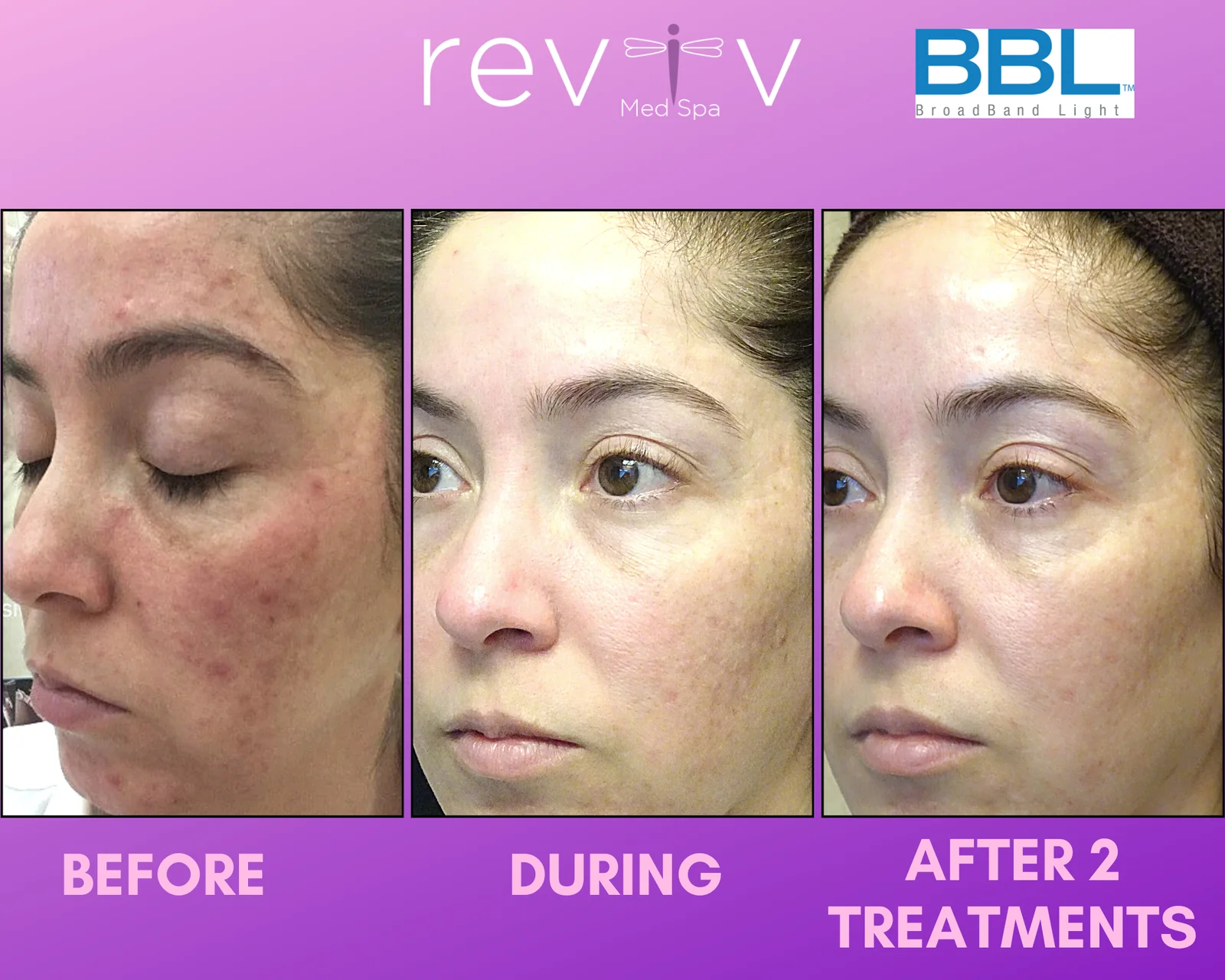 Reviv Med Spa patient before and after — BBL Hero, Millbrae, California