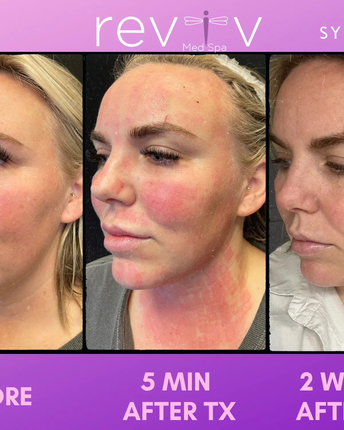 Reviv Med Spa patient before and after — Sylfirm X, Millbrae, California