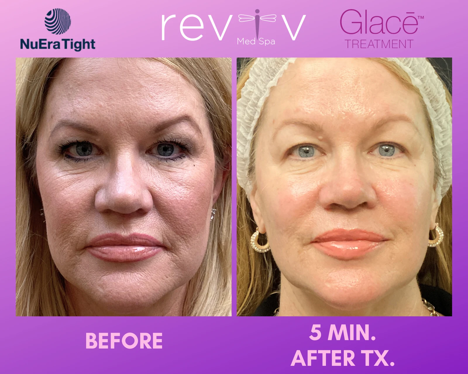 A Glacé facial, before and 5 minutes after