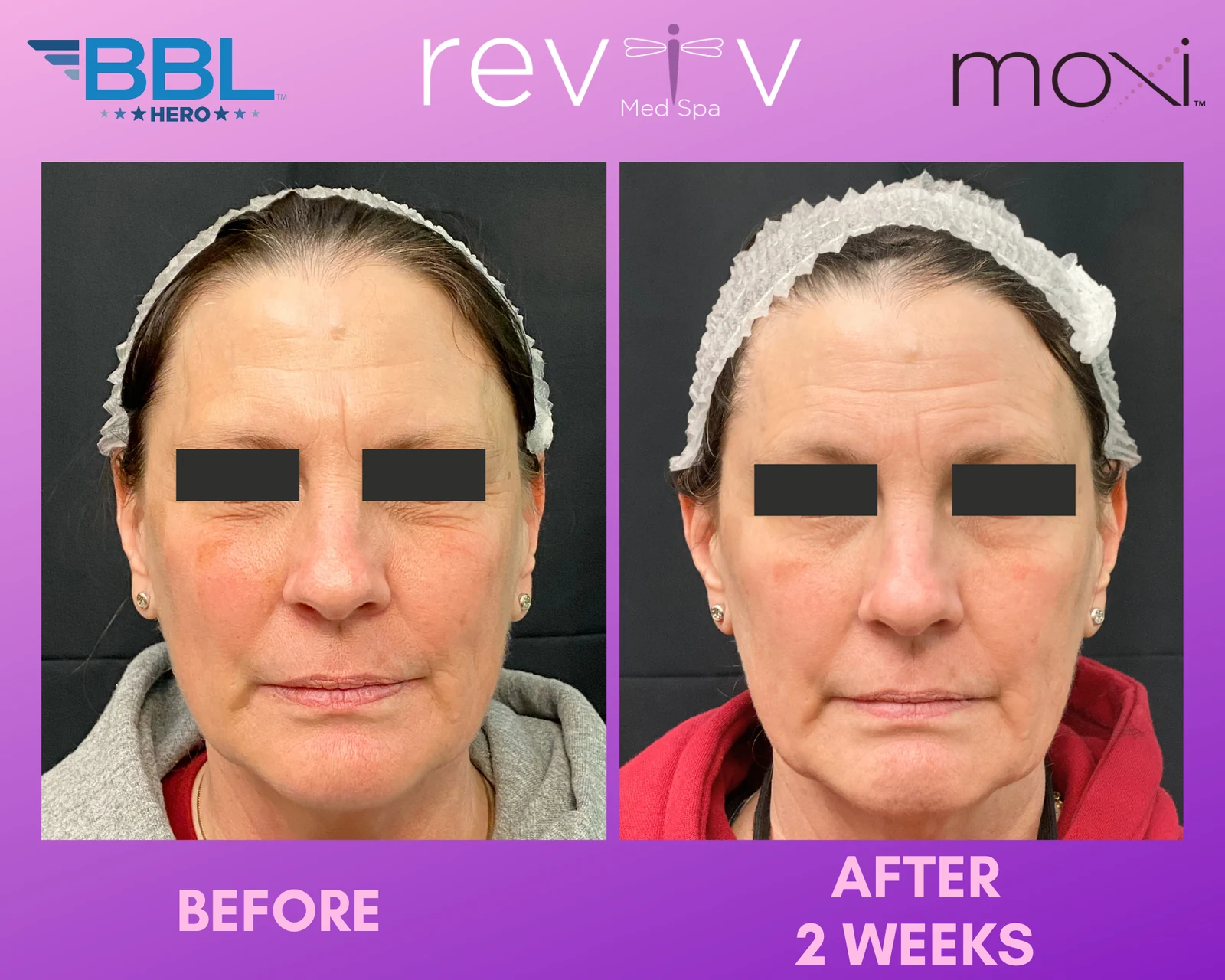Reviv Med Spa patient before and after — BBL + MOXI, Millbrae, California