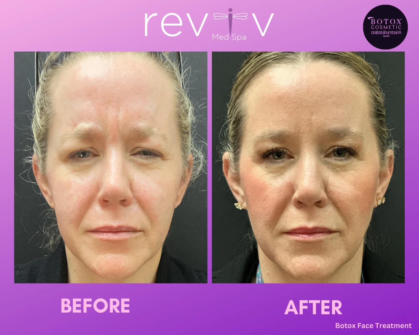 Botox on the face, before and after