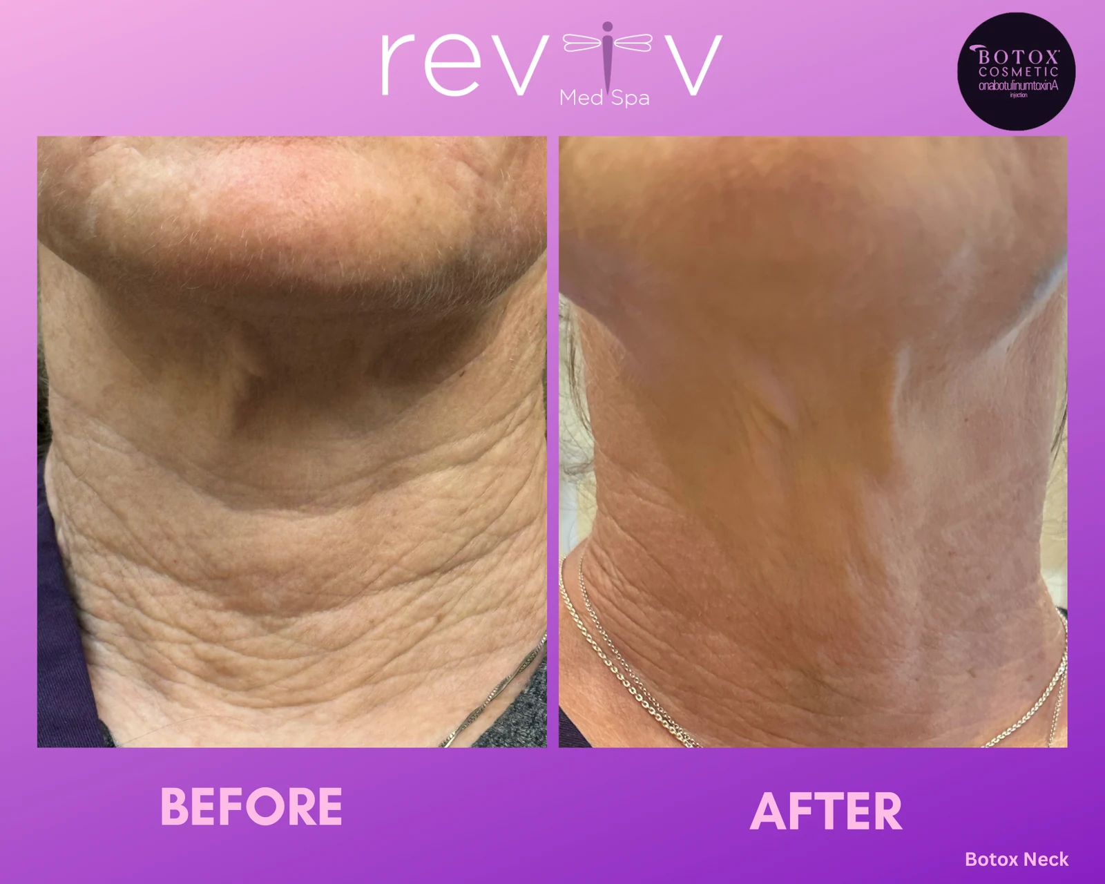 Reviv Med Spa patient before and after — Botox · Neck, Millbrae, California