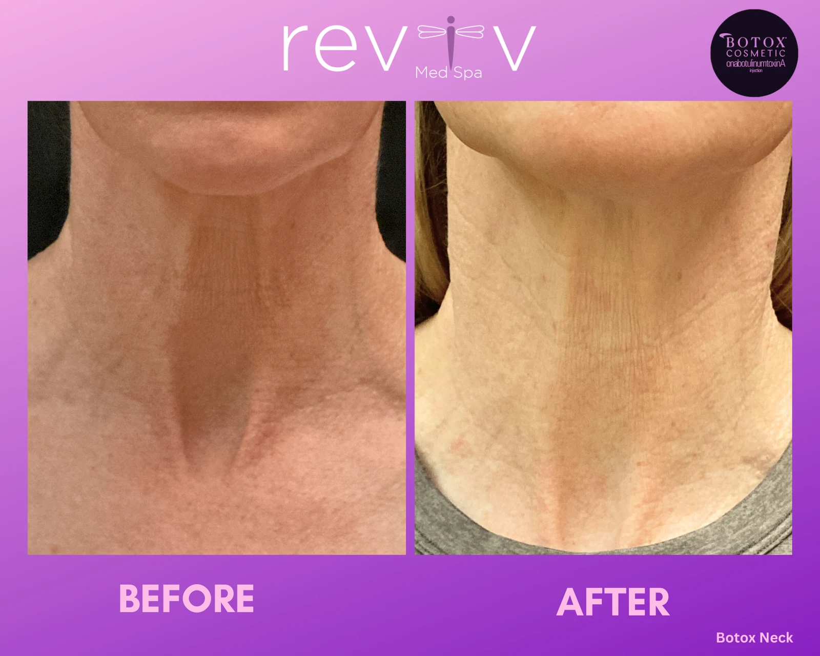 Reviv Med Spa patient before and after — Botox · Neck, Millbrae, California