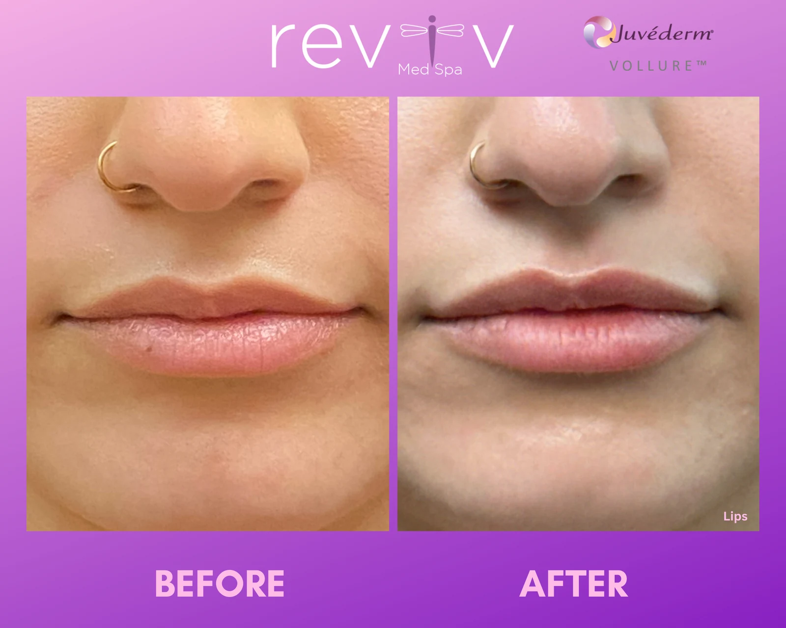 Reviv Med Spa patient before and after — Dermal Fillers, Millbrae, California