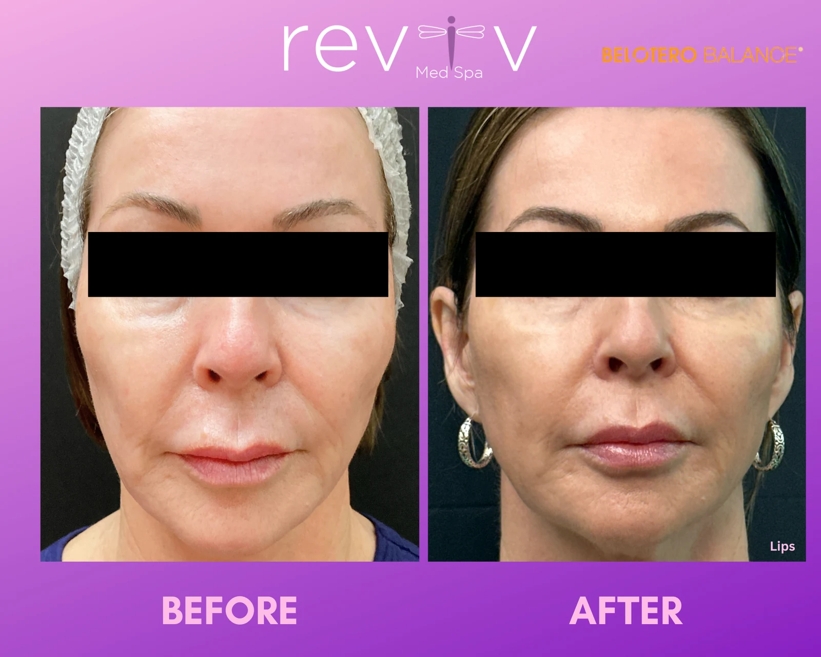 Reviv Med Spa patient before and after — Dermal Fillers, Millbrae, California