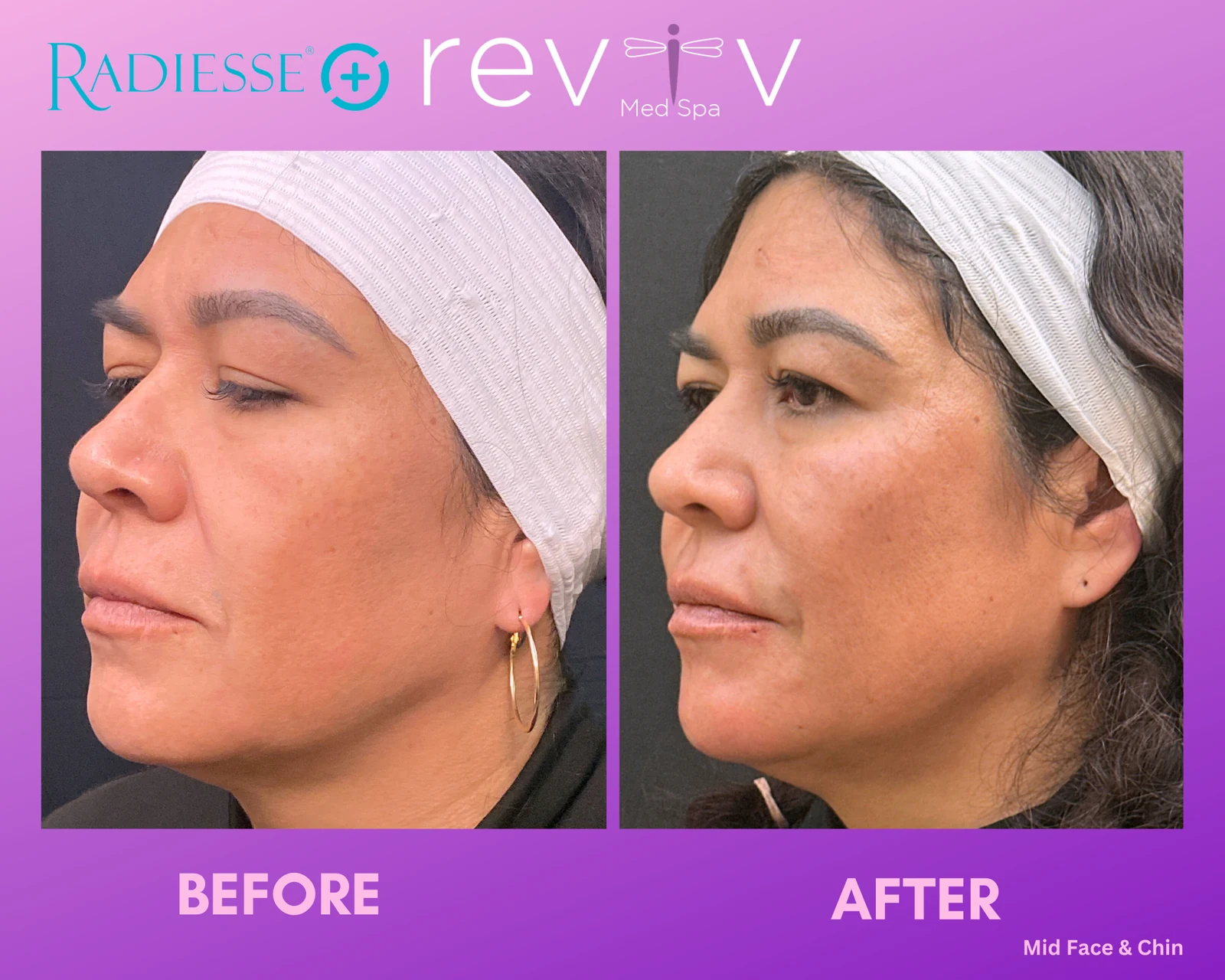 Dermal filler in the mid-face and chin, before and after