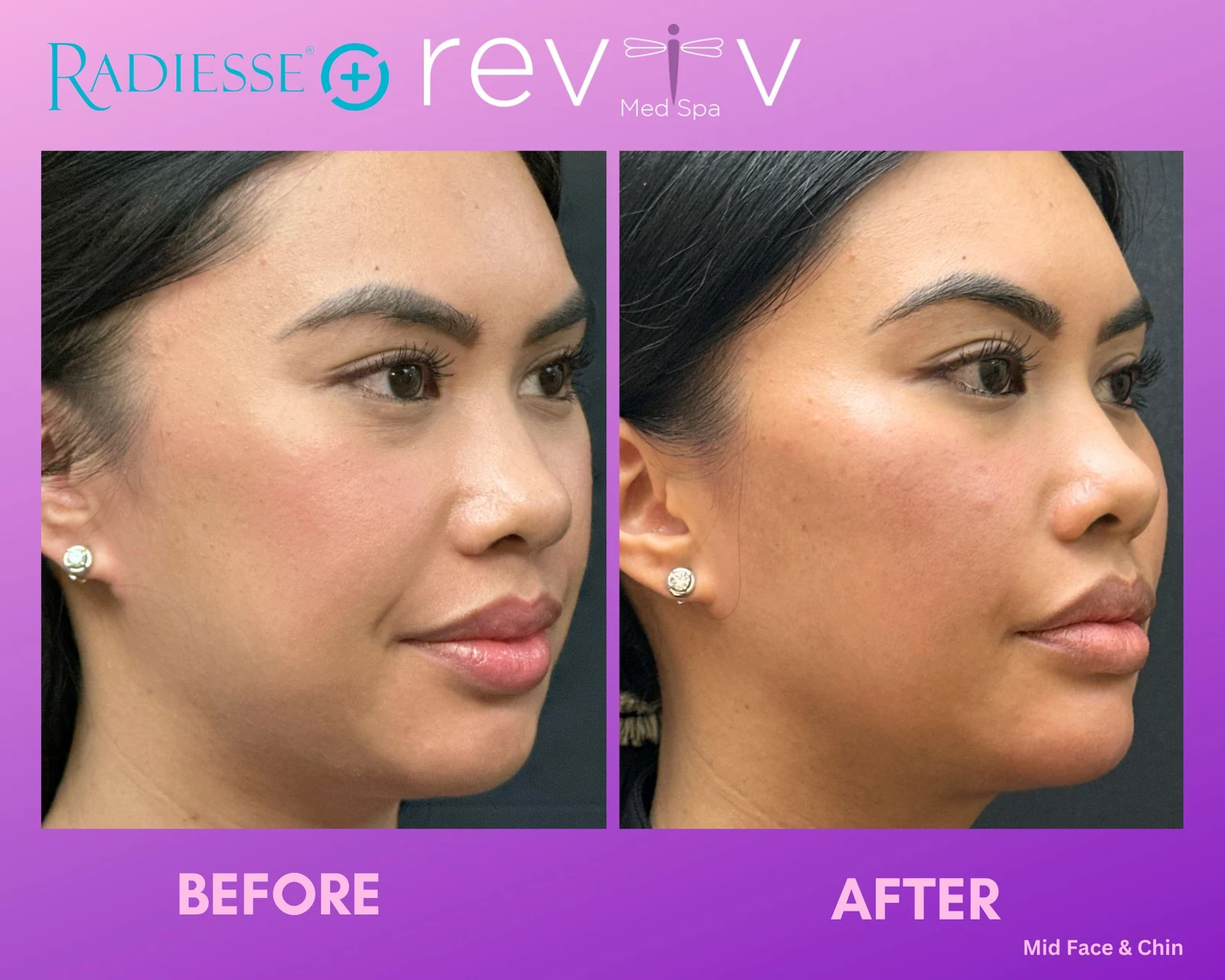Reviv Med Spa patient before and after — Dermal Fillers, Millbrae, California
