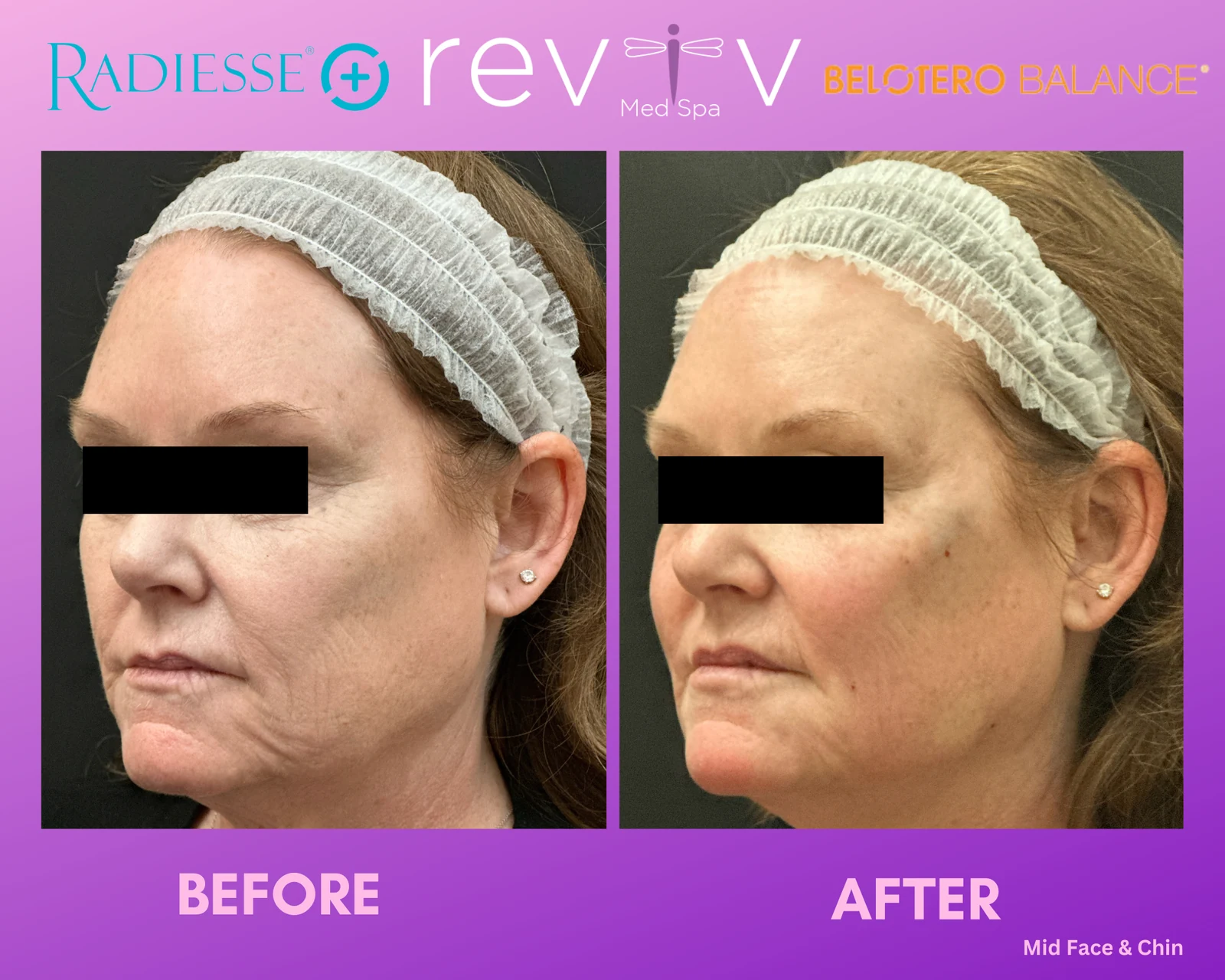 Reviv Med Spa patient before and after — Dermal Fillers, Millbrae, California