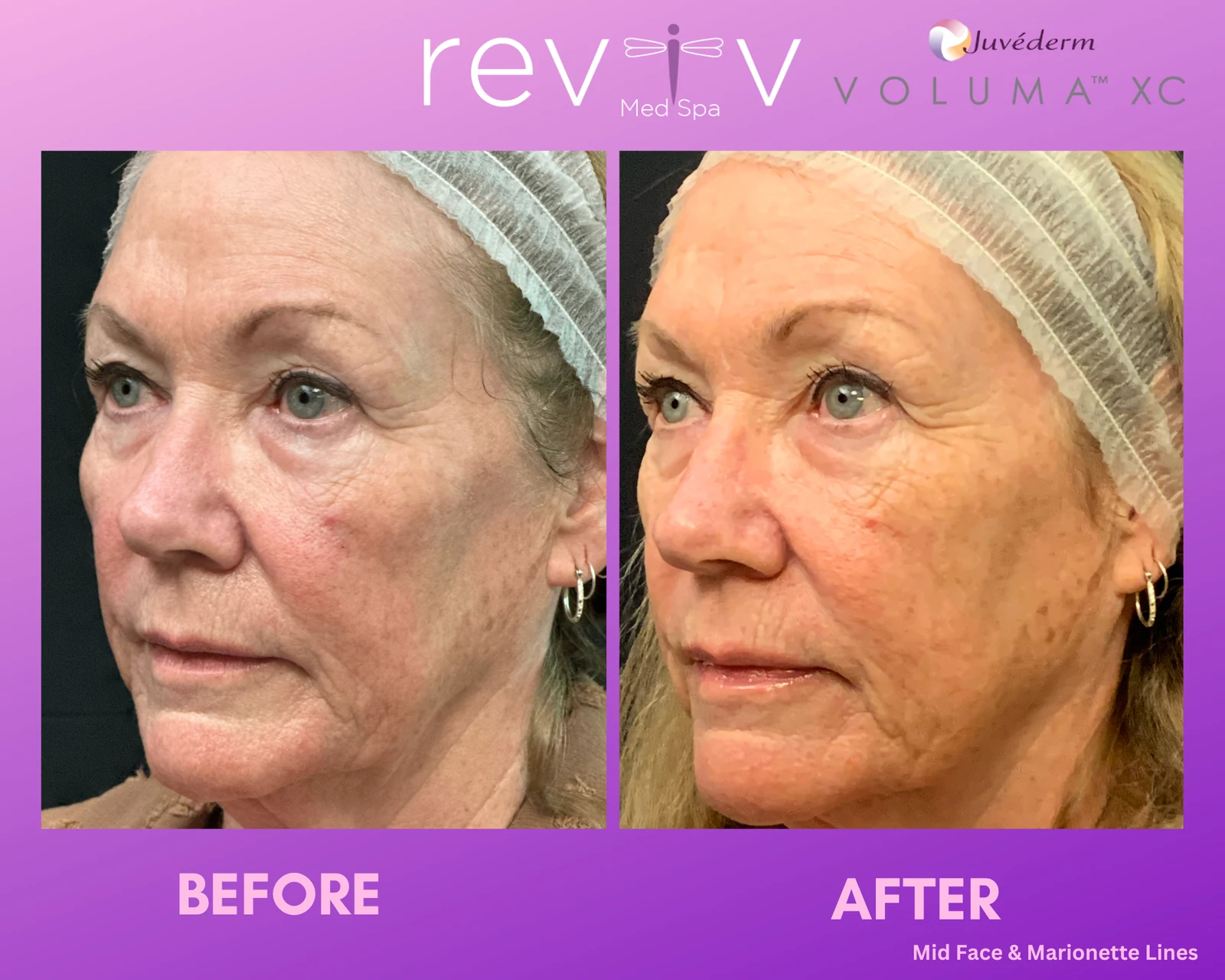 Dermal filler in the mid-face and marionette lines, before and after