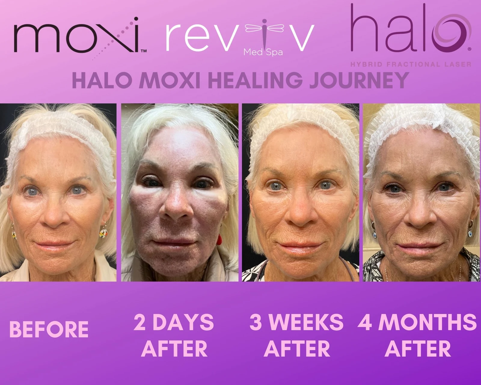 Halo + MOXI Resurfacing