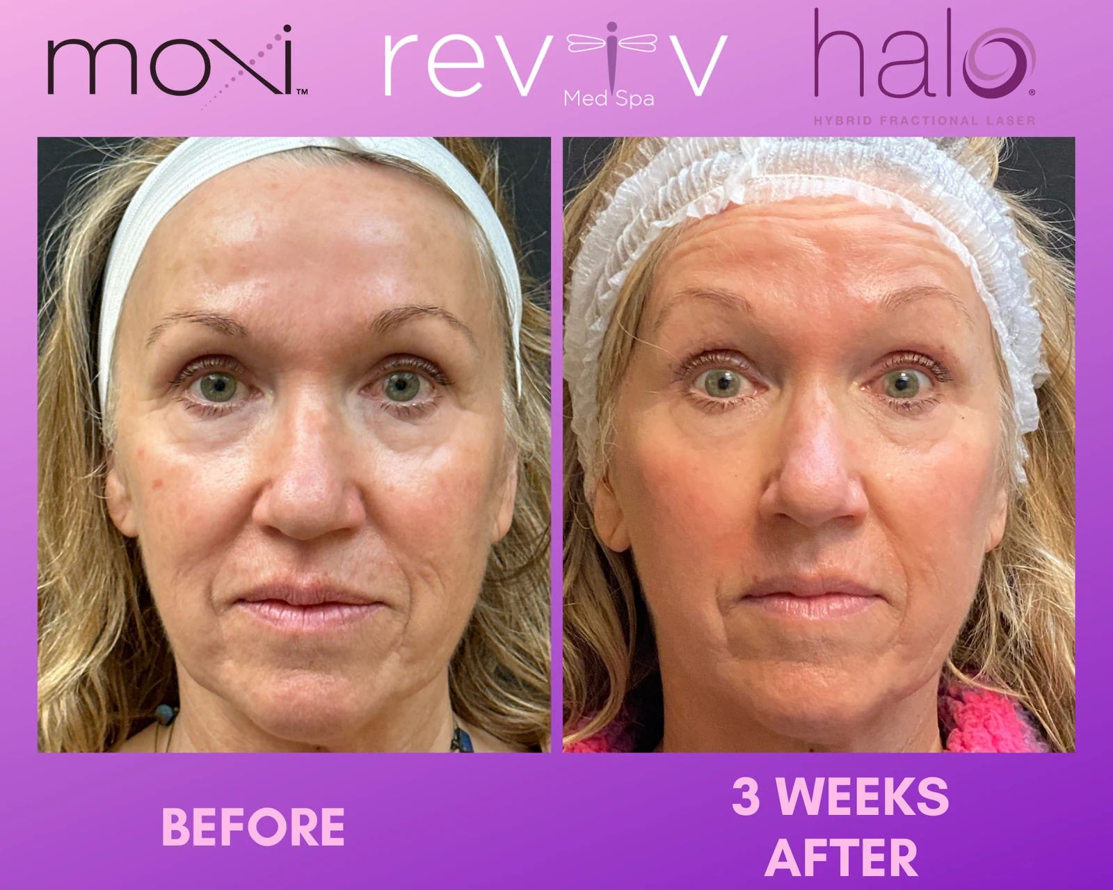 Reviv Med Spa patient before and after — Halo + MOXI, Millbrae, California