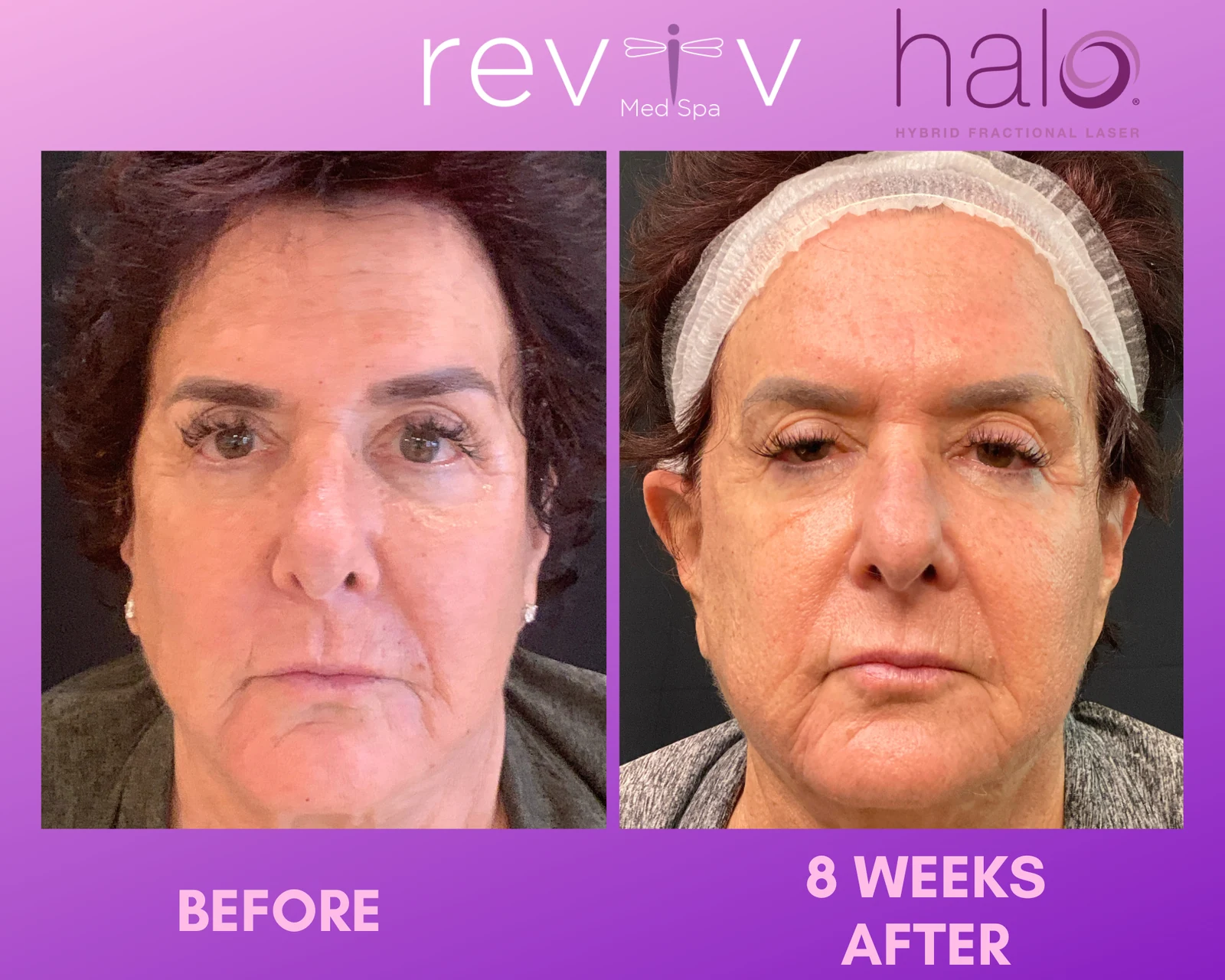 Reviv Med Spa patient before and after — Halo, Millbrae, California