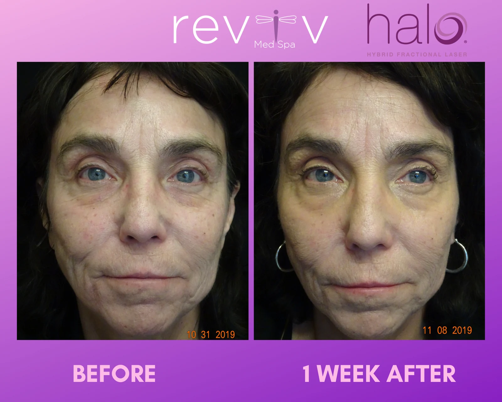 Reviv Med Spa patient before and after — Halo, Millbrae, California