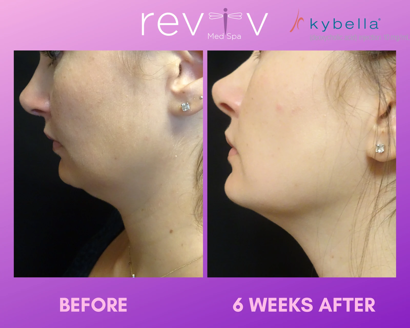 Kybella under the chin, before and 6 weeks after