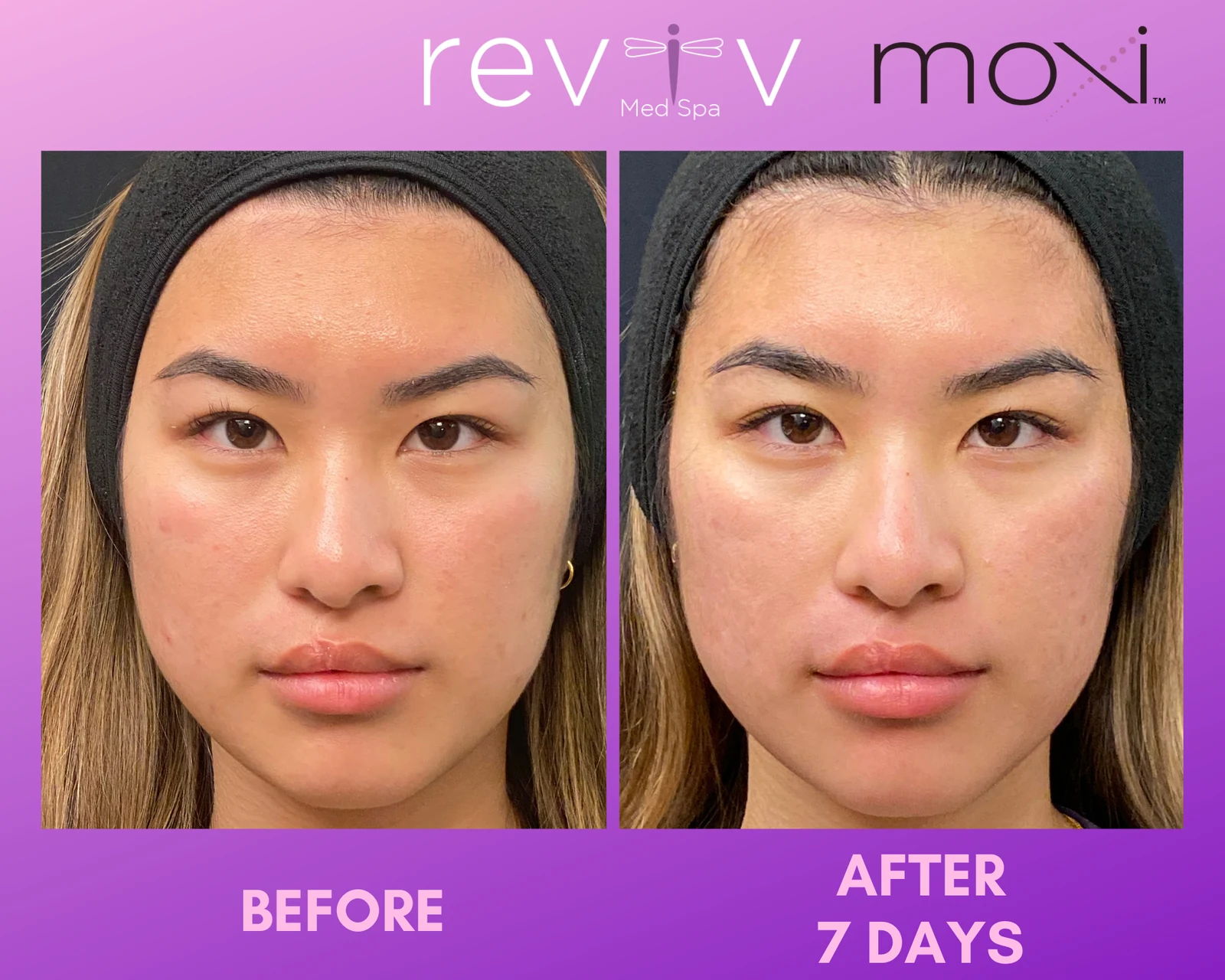 Reviv Med Spa patient before and after — MOXI, Millbrae, California
