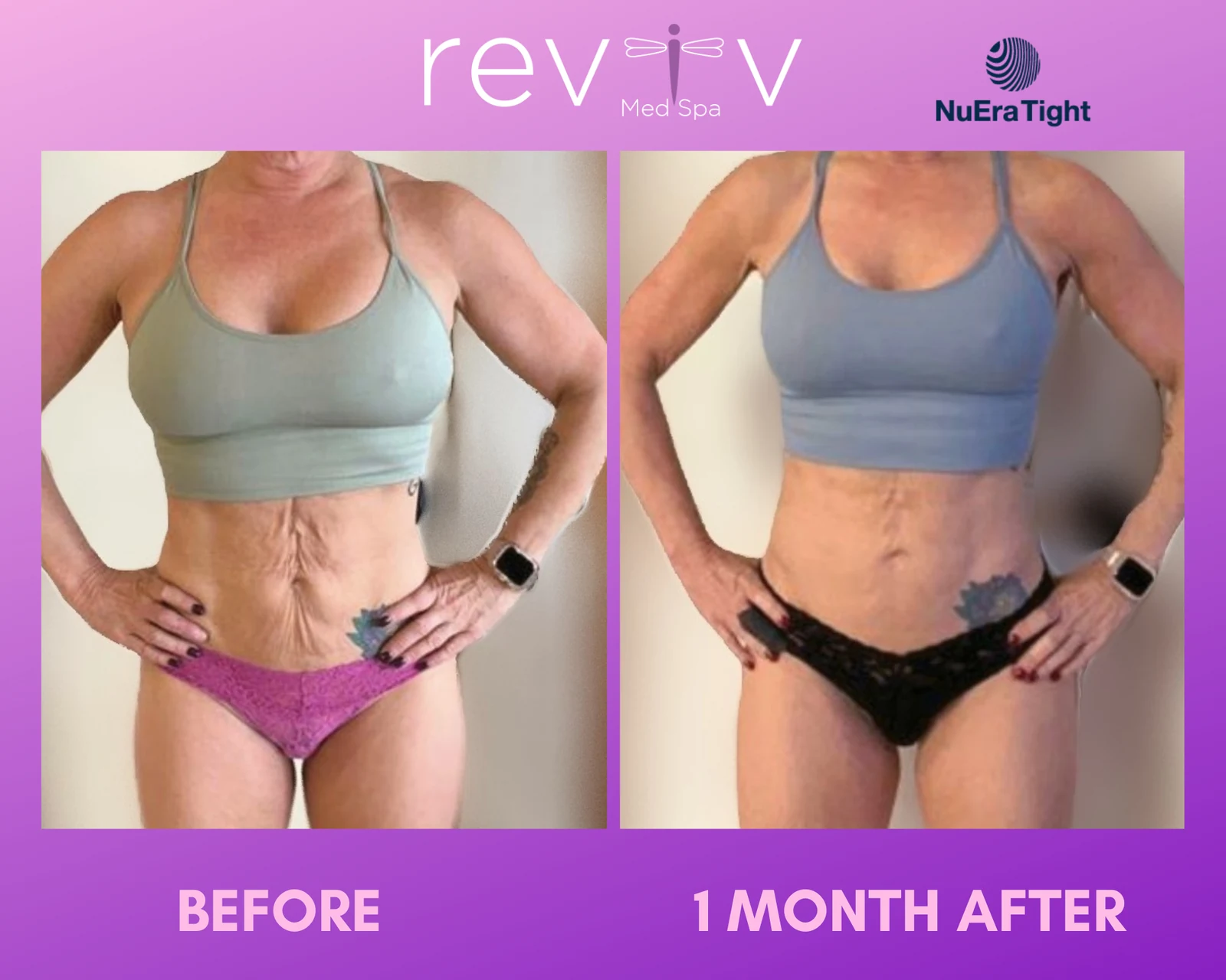 Reviv Med Spa patient before and after — NuEra Tight RF, Millbrae, California