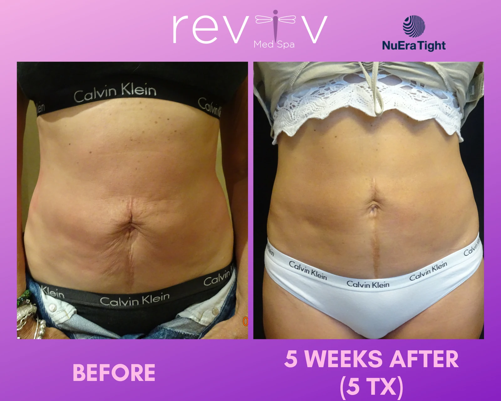 NuEra Tight RF skin tightening on the abdomen, before and 5 weeks after