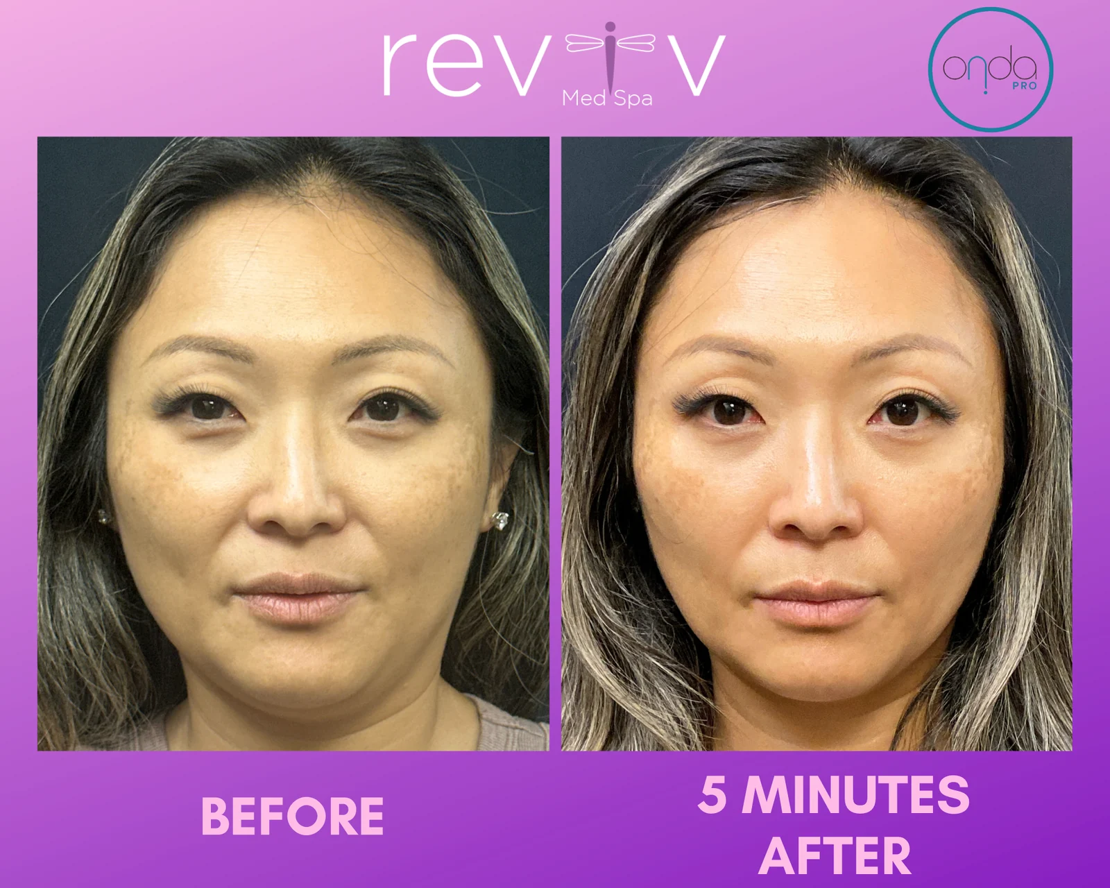 ONDA Pro Coolwaves on the face and jawline — before and 5 minutes after a single session