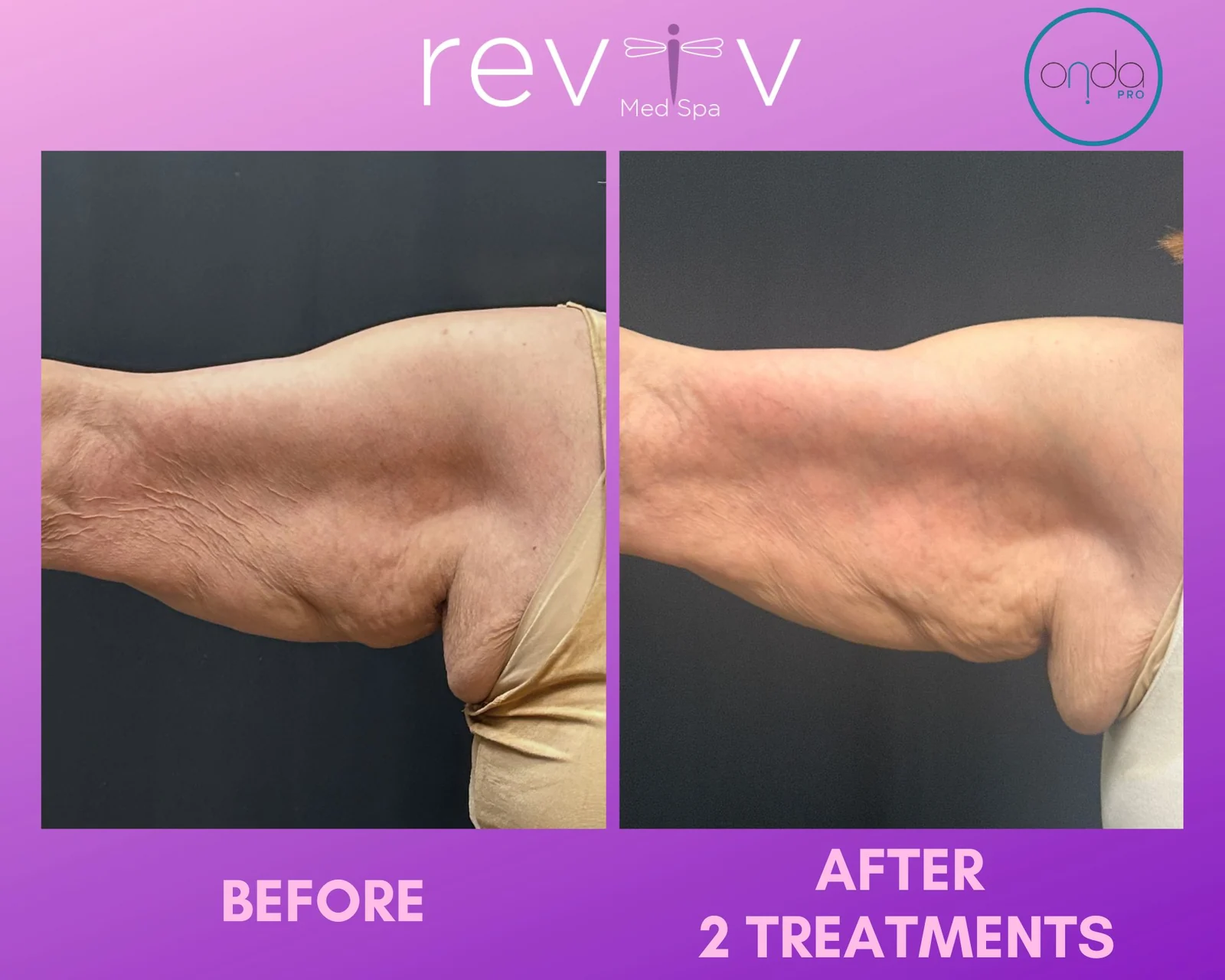 ONDA Pro Coolwaves® · upper arms, after two sessions of a planned series