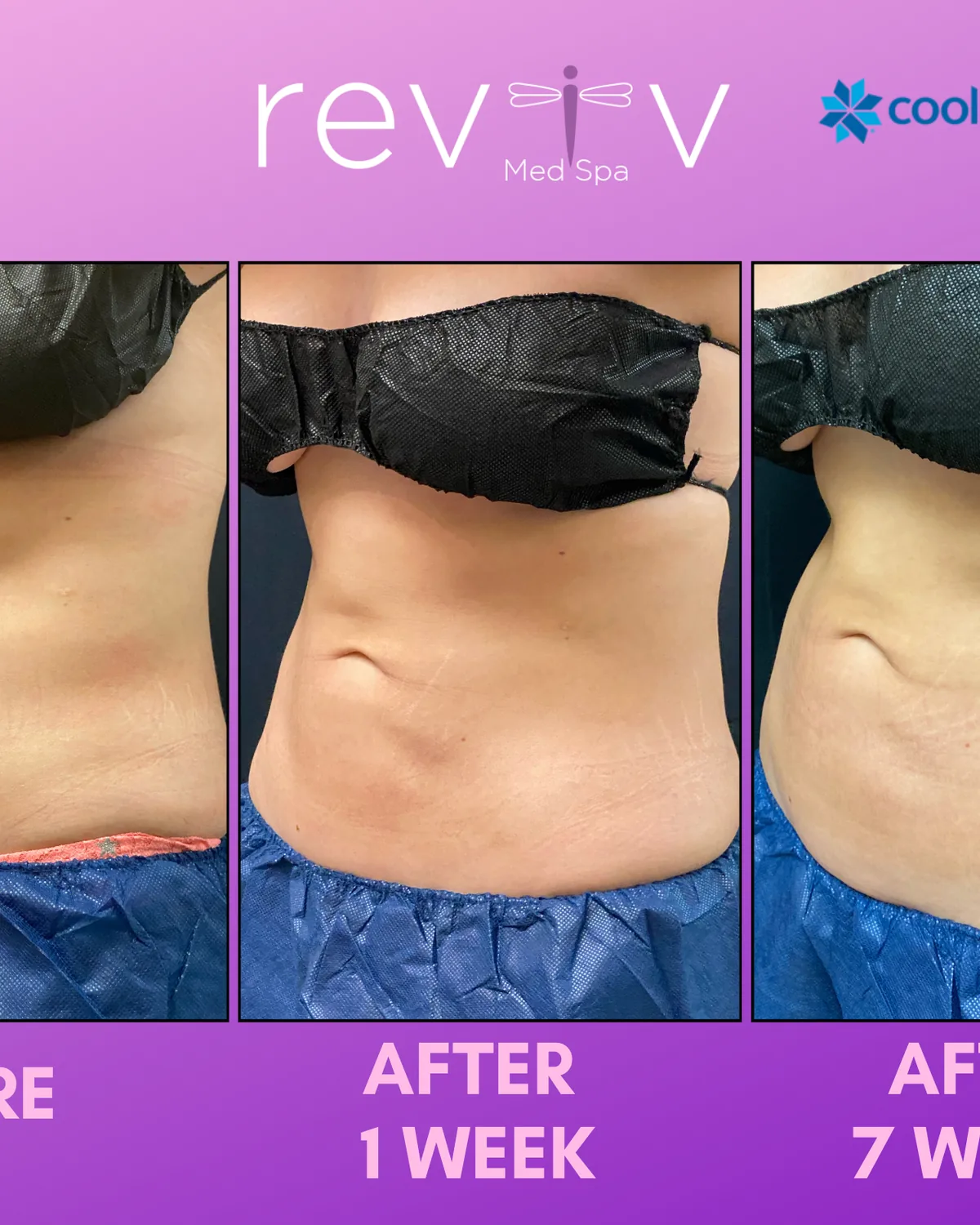 CoolSculpting Elite abdomen result