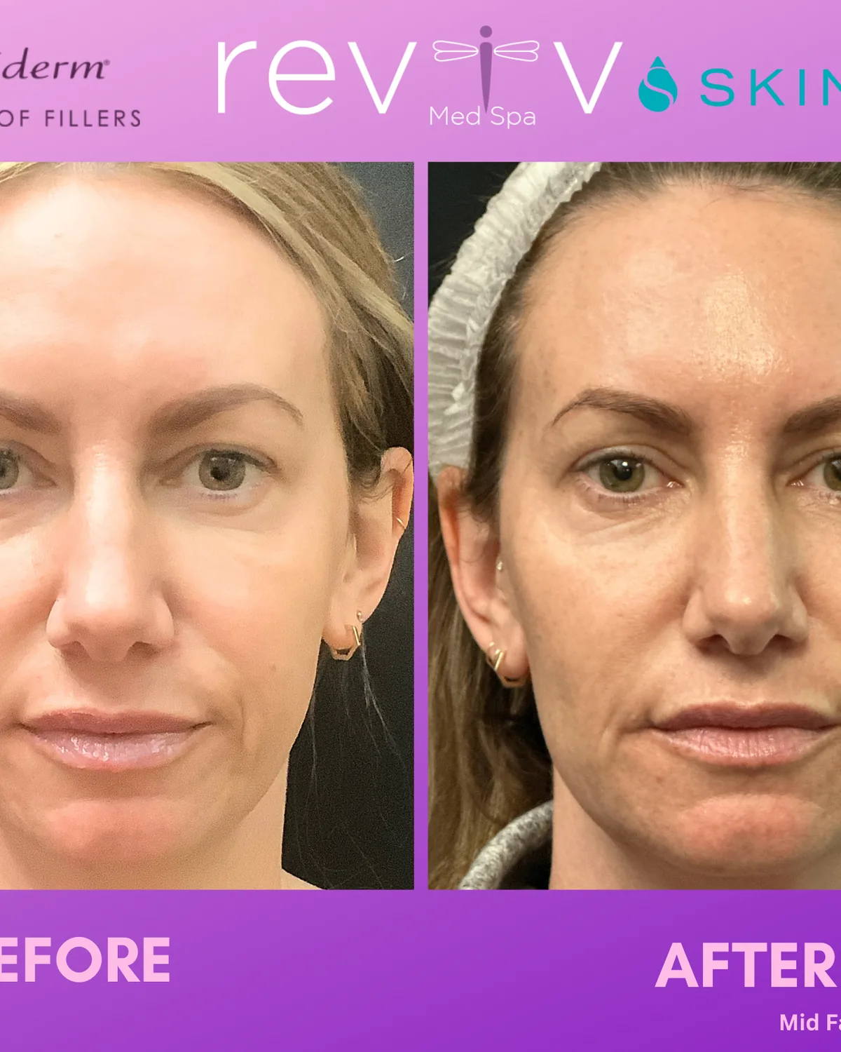 Skinvive microdroplet hydrator result