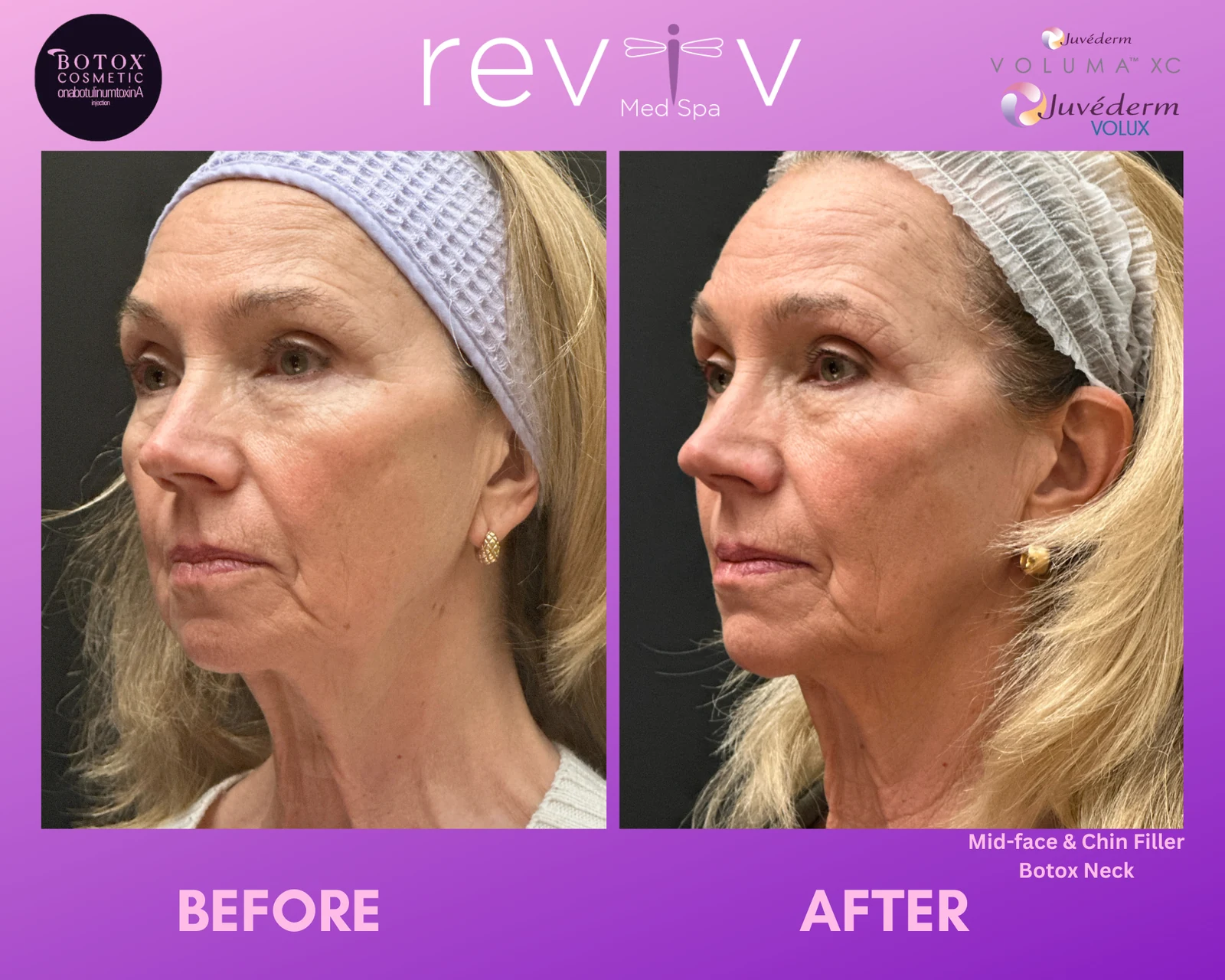 Botox · platysmal bands