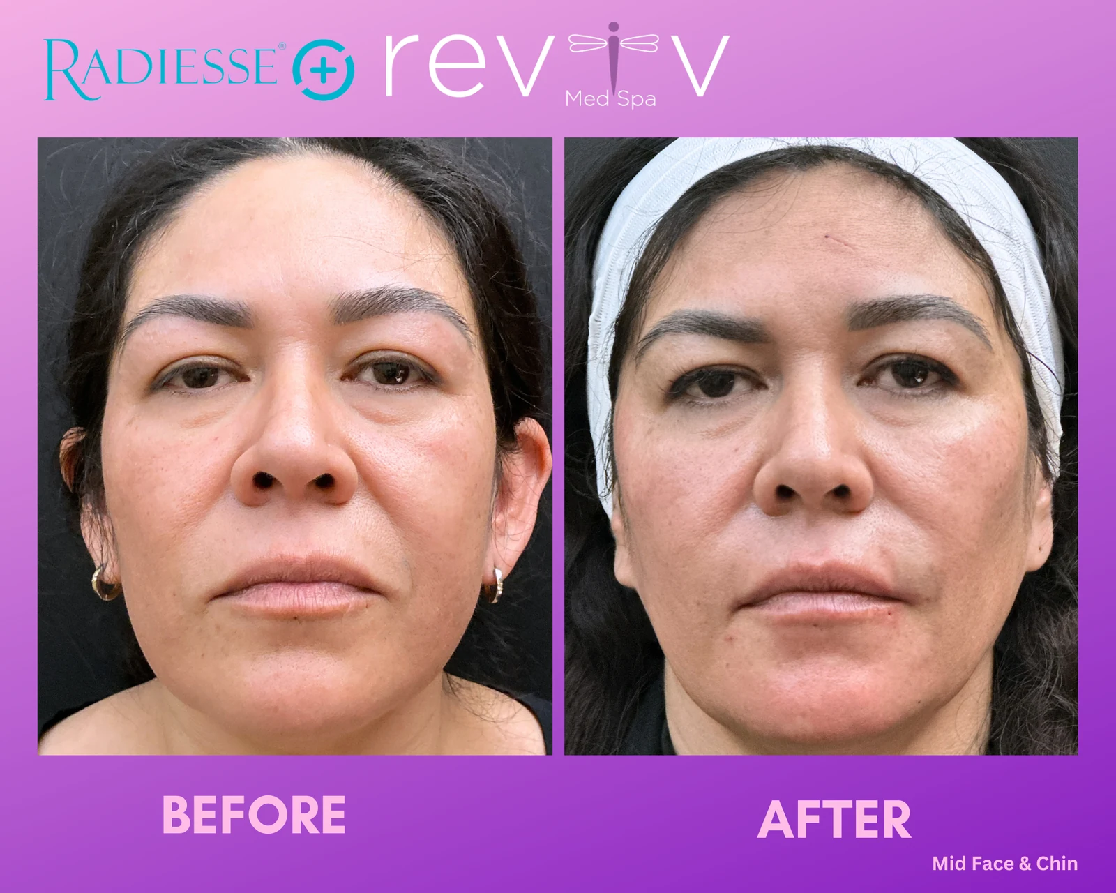Reviv patient — Dermal Fillers (undefined)