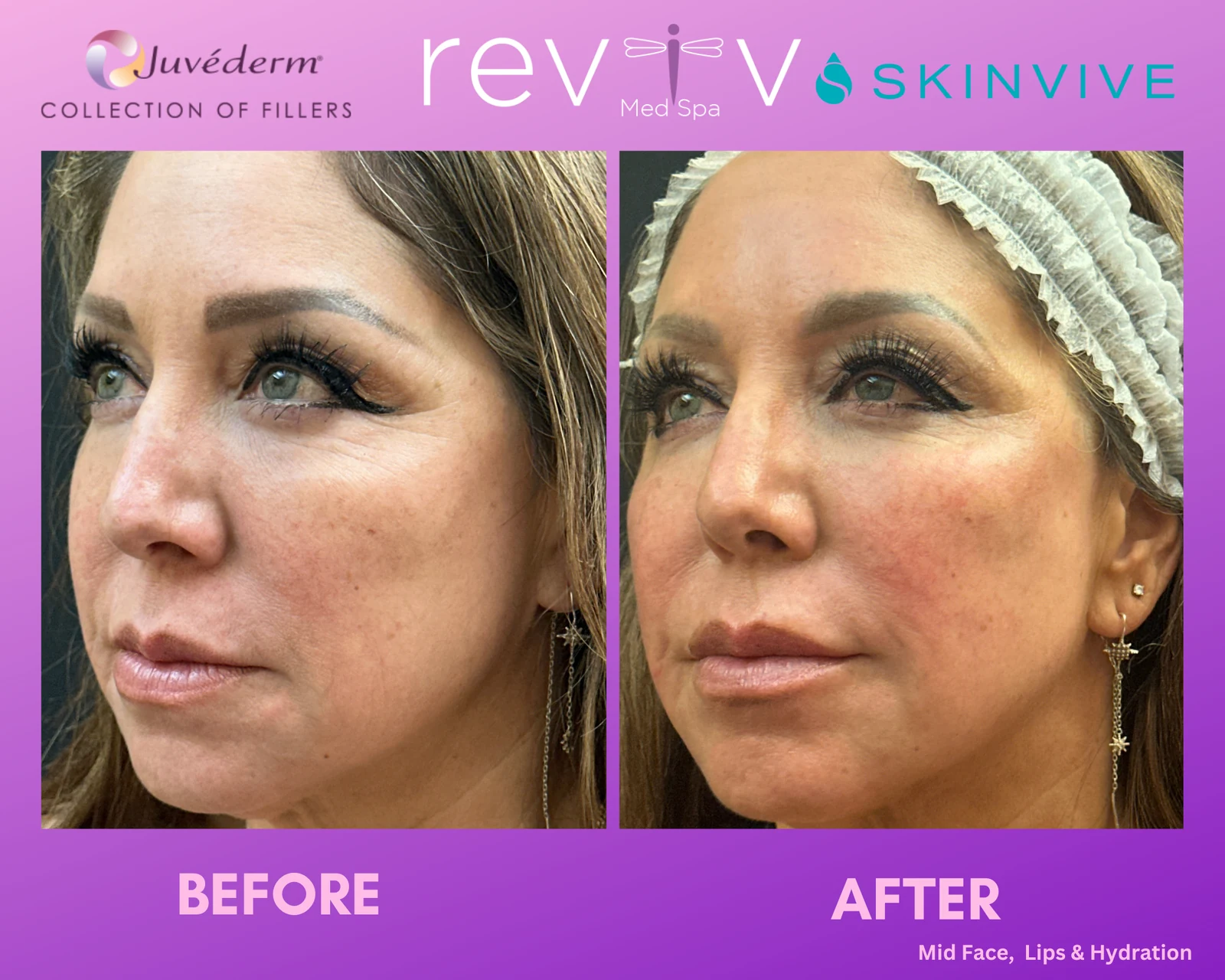 Reviv patient — Dermal Fillers (undefined)