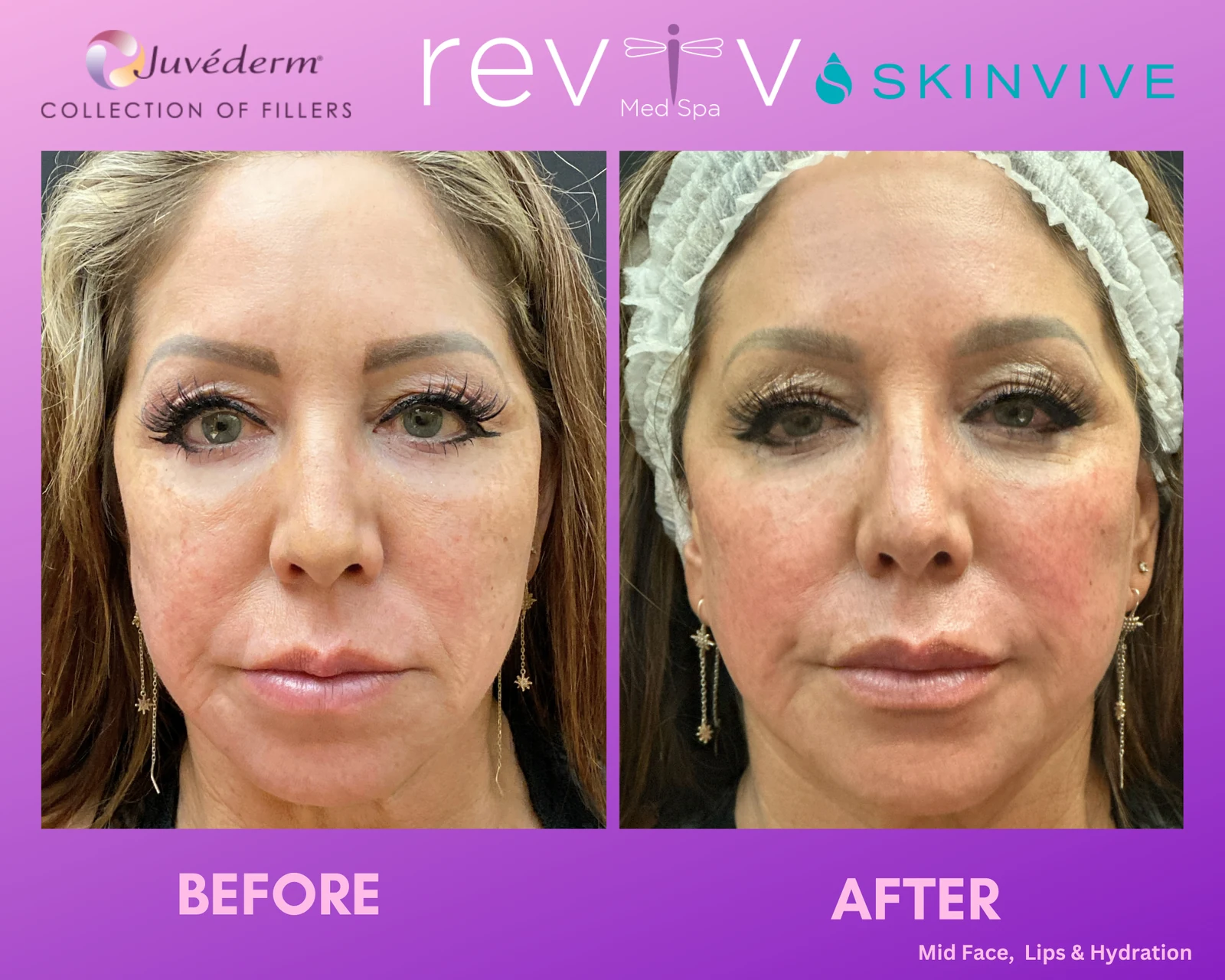 Reviv patient — Dermal Fillers (undefined)