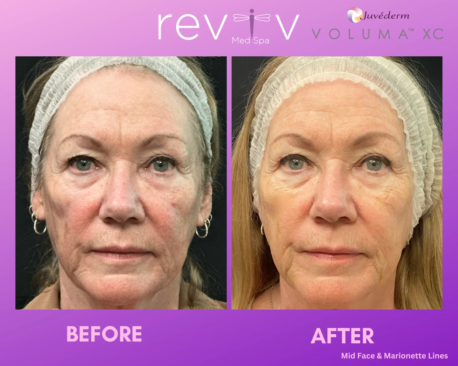 Reviv patient — Dermal Fillers (undefined)