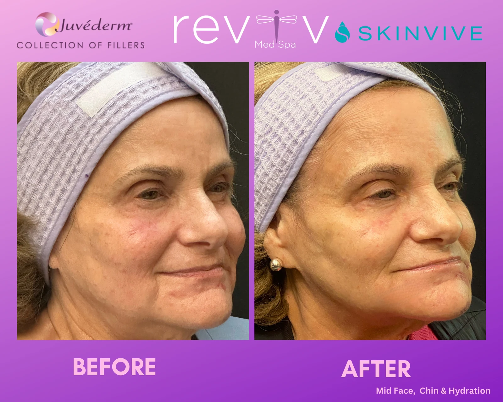 Reviv patient — Dermal Fillers (undefined)