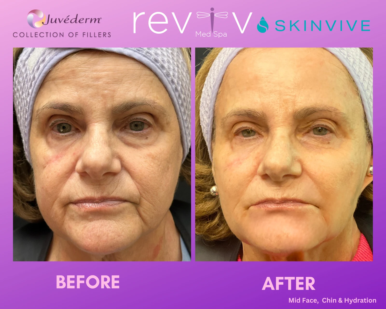 Reviv patient — Dermal Fillers (undefined)