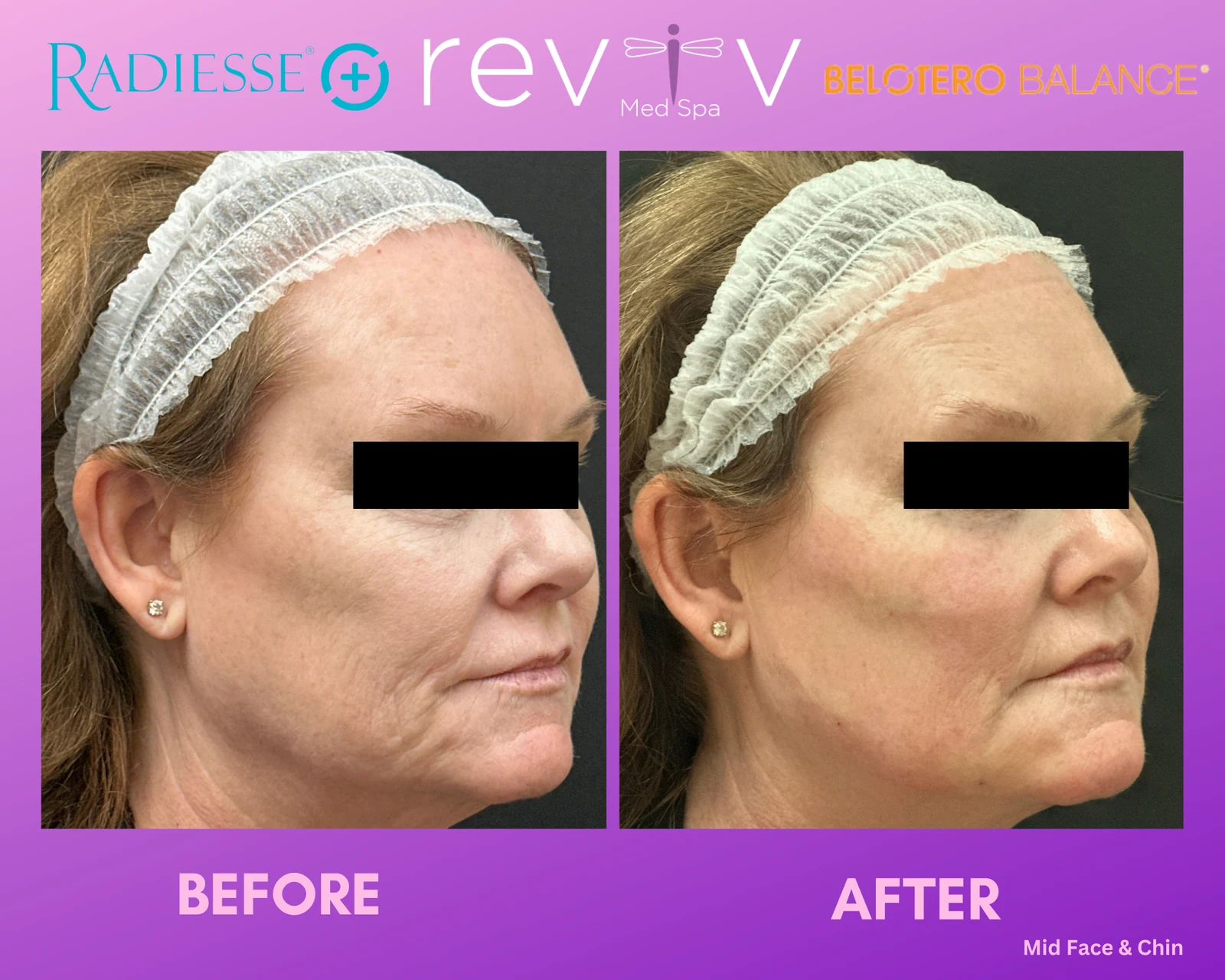 Reviv patient — Dermal Fillers (undefined)