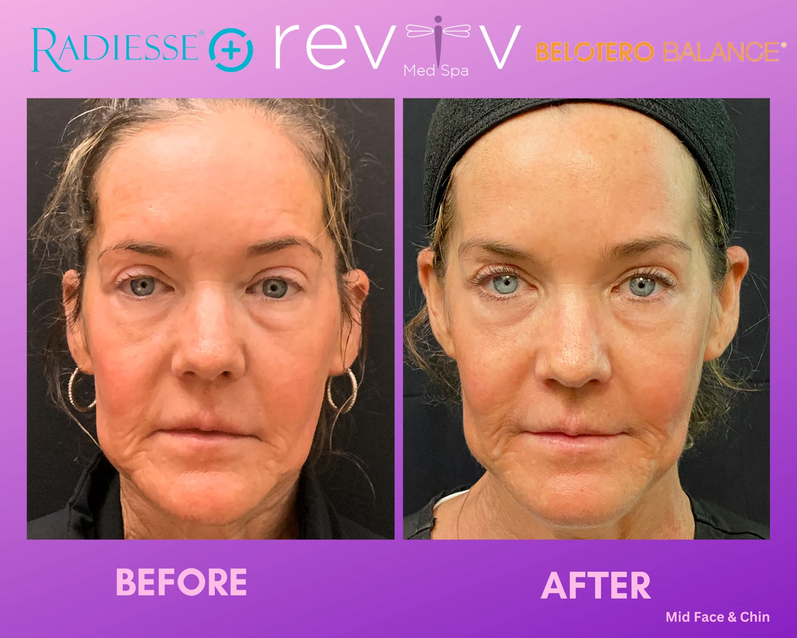 Reviv patient — Dermal Fillers (undefined)