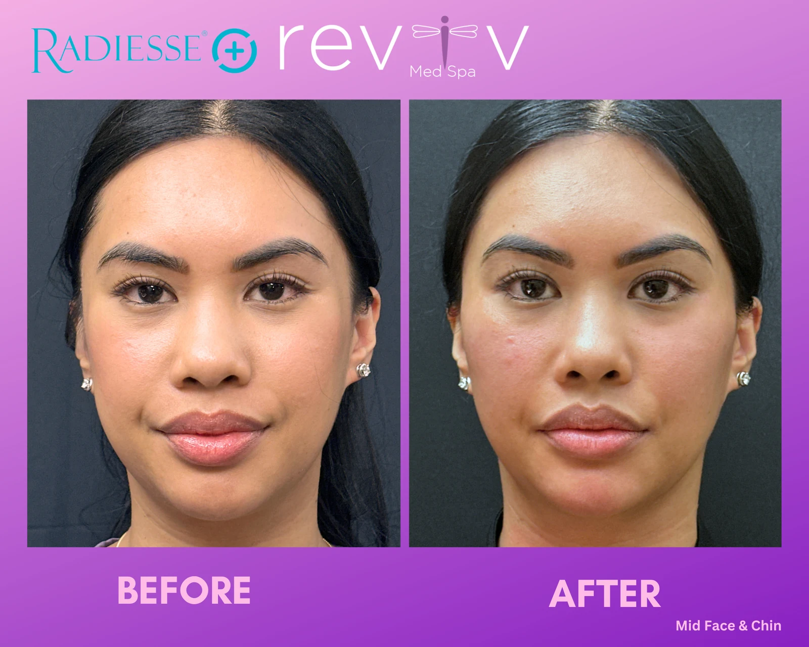 Reviv patient — Dermal Fillers (undefined)