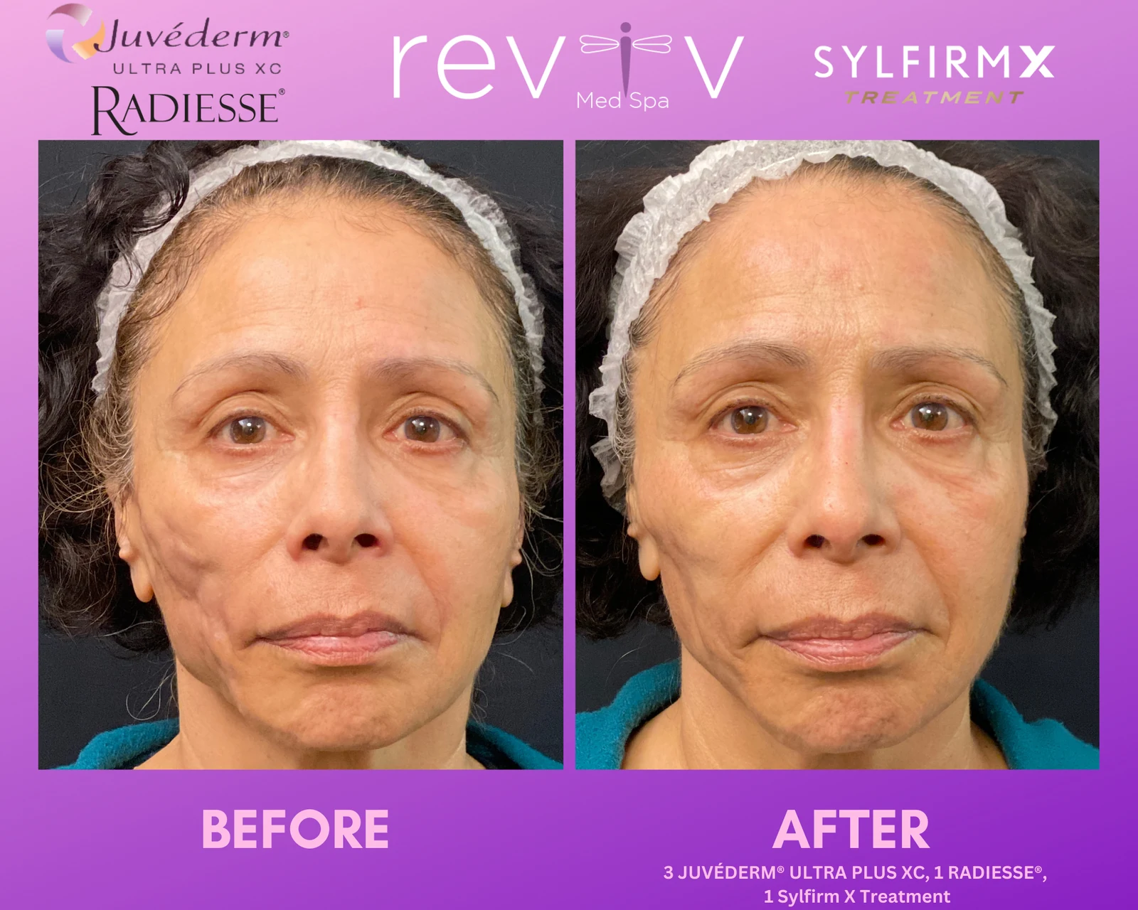 Reviv patient — Sylfirm + Filler (undefined)