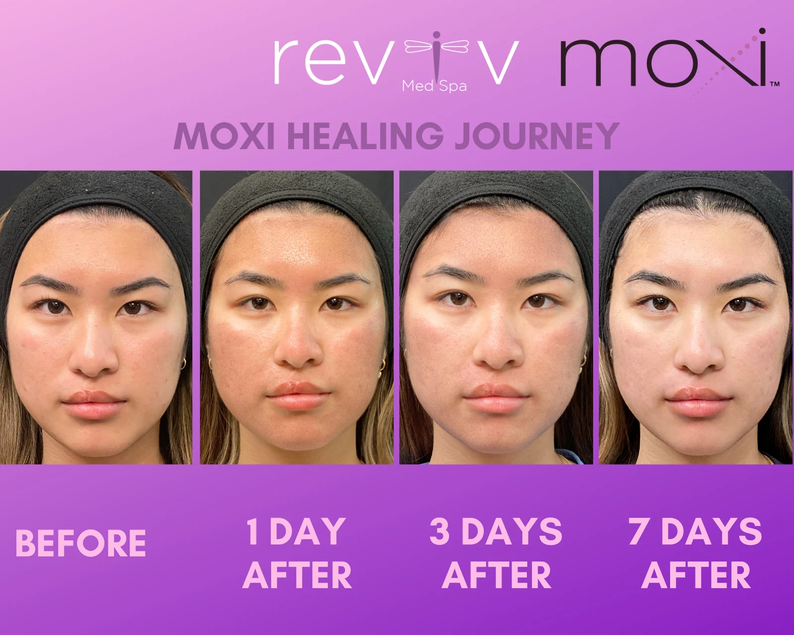 Reviv patient — MOXI (undefined)