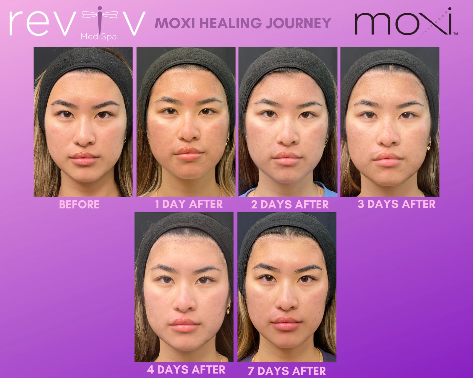 Reviv patient — MOXI (undefined)