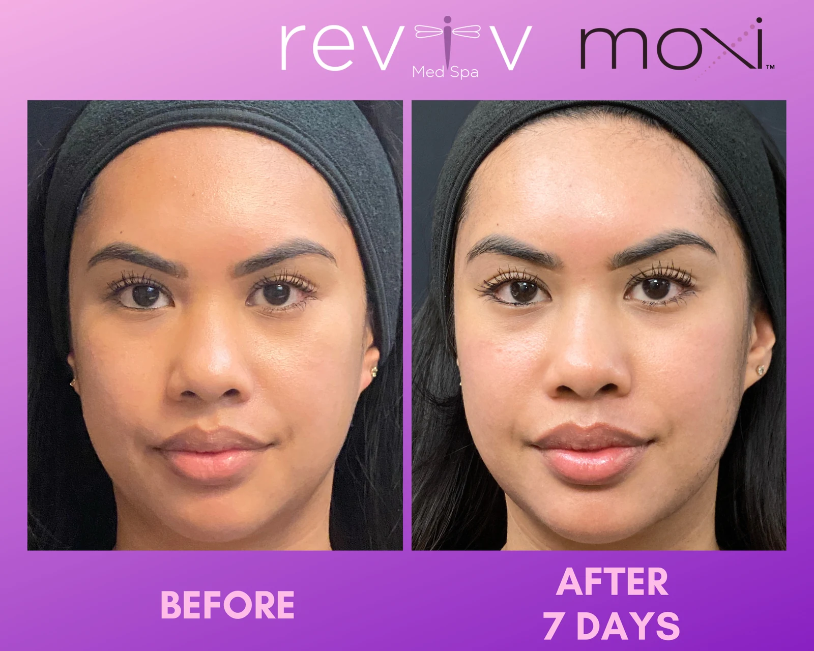 Reviv patient — MOXI (undefined)