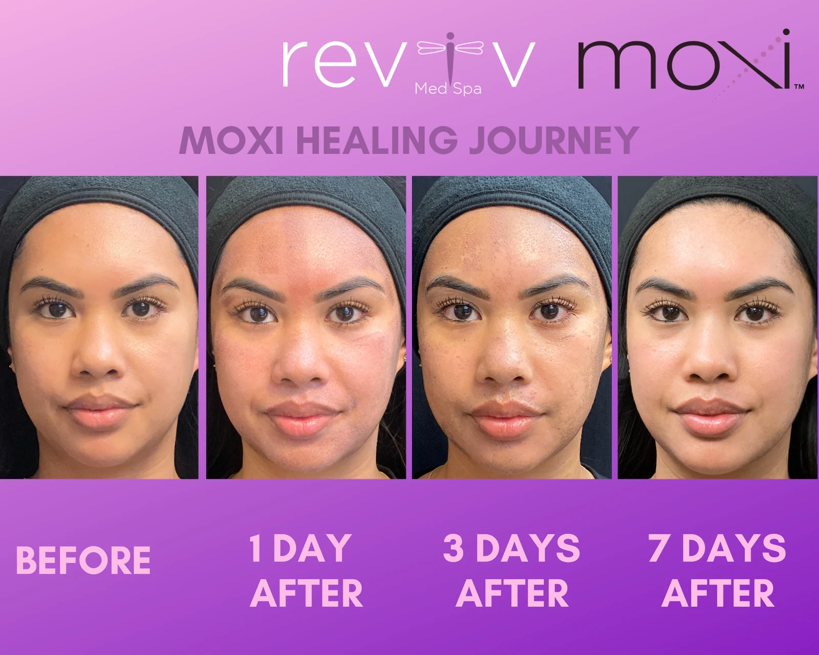 Reviv patient — MOXI (undefined)
