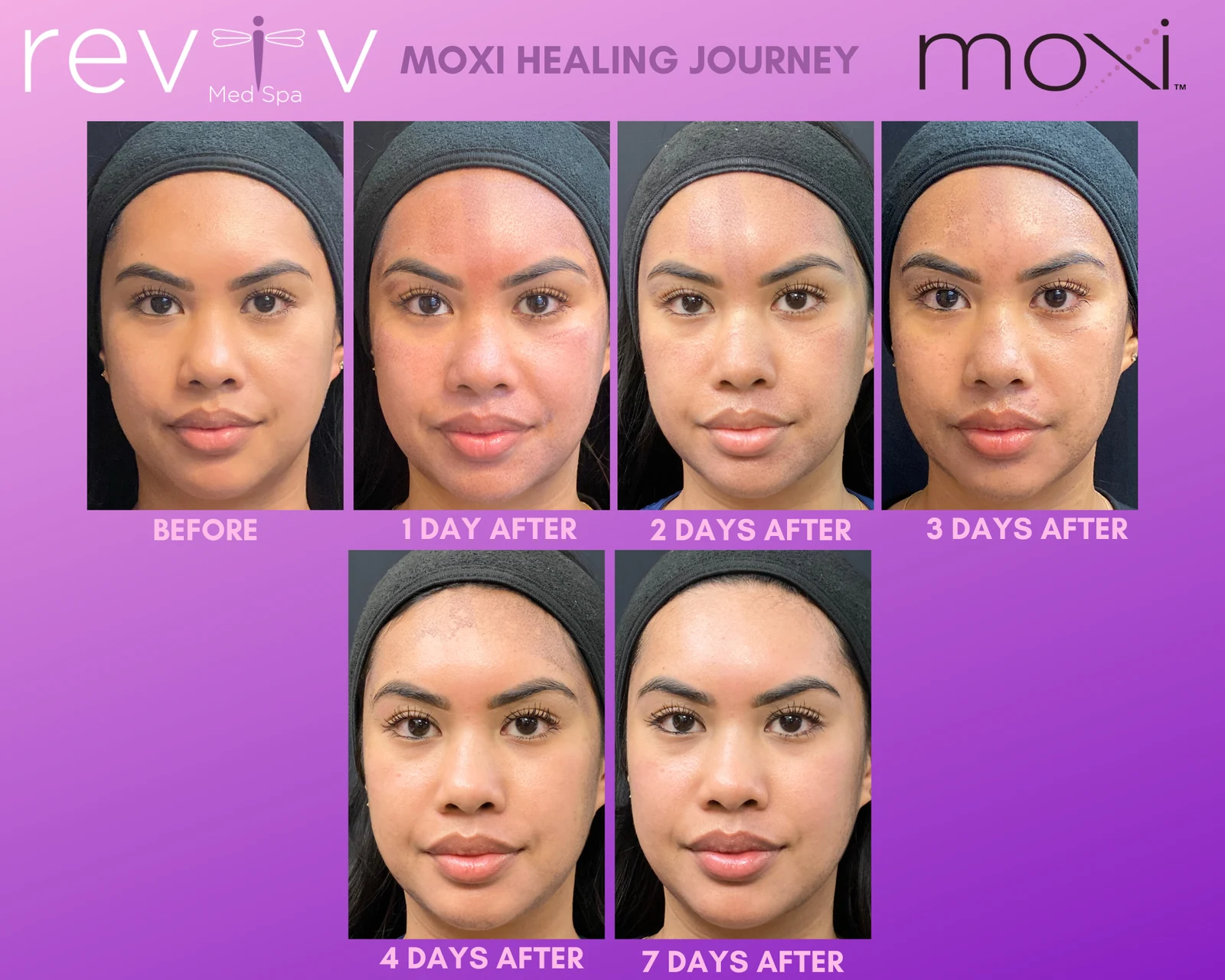 Reviv patient — MOXI (undefined)