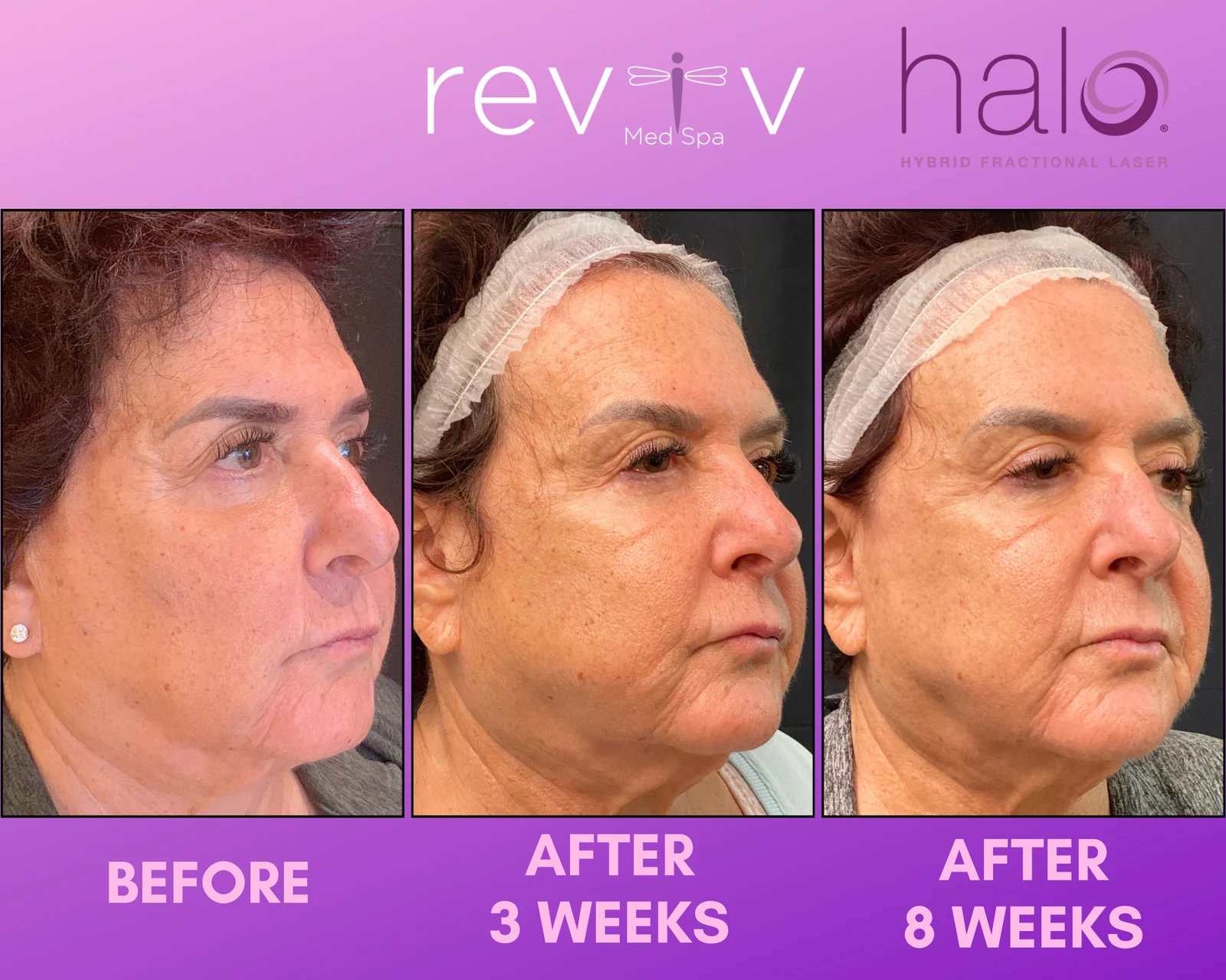 Reviv patient — Halo (undefined)