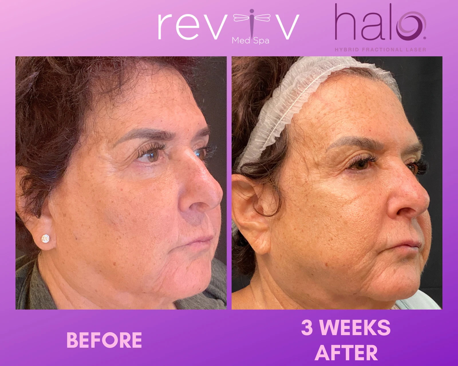 Reviv patient — Halo (undefined)